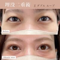 画像1471：脂肪注入（額＋こめかみ＋頬＋ほうれい線＋マリオネットライン＋ゴルゴライン）