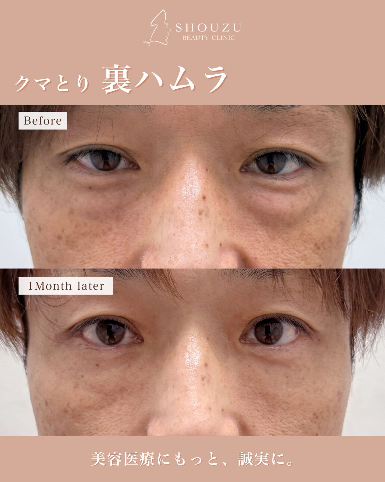 脂肪注入（額＋こめかみ＋頬＋ほうれい線＋マリオネットライン＋ゴルゴライン）