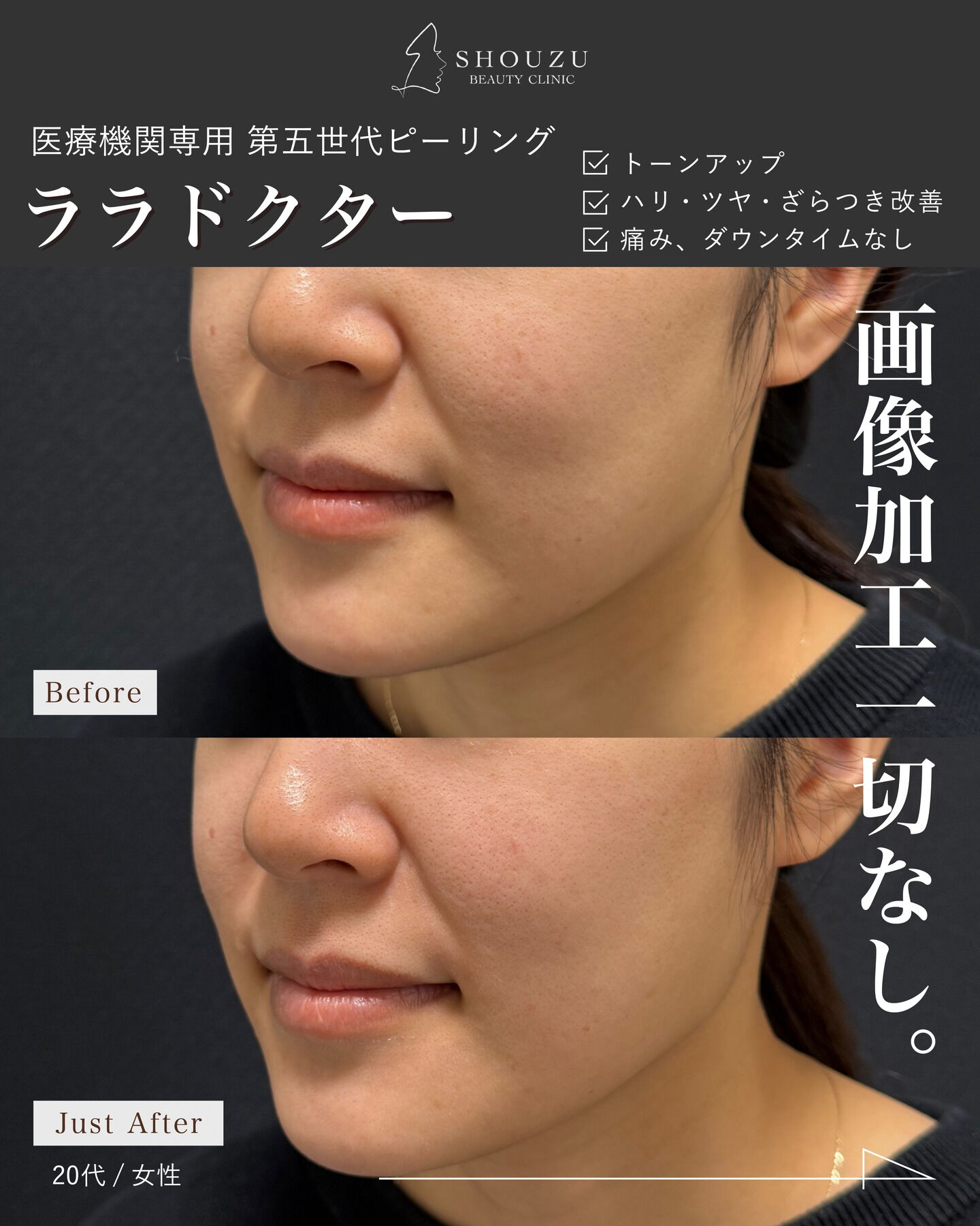 .大人気ピーリング