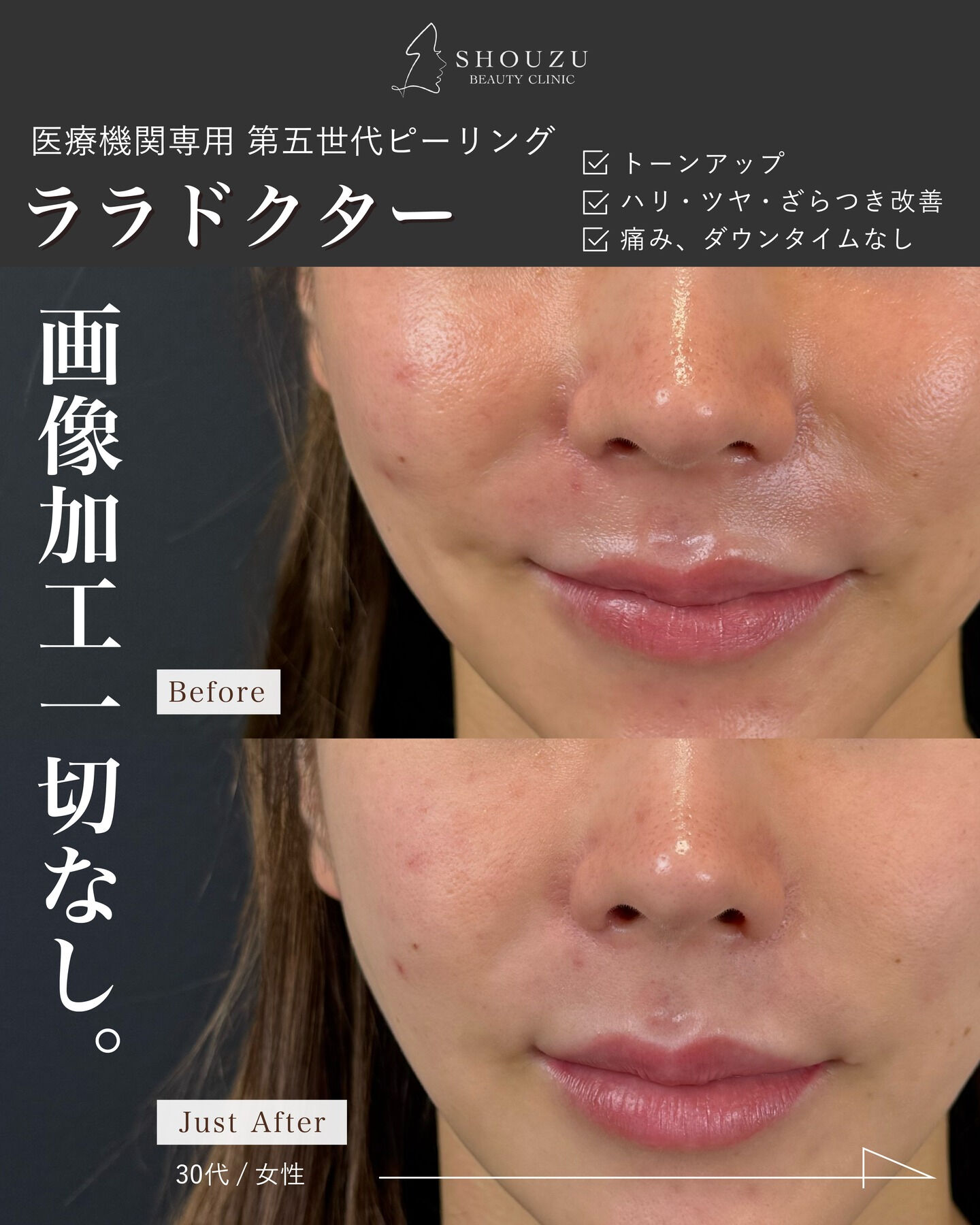 .大人気ピーリング