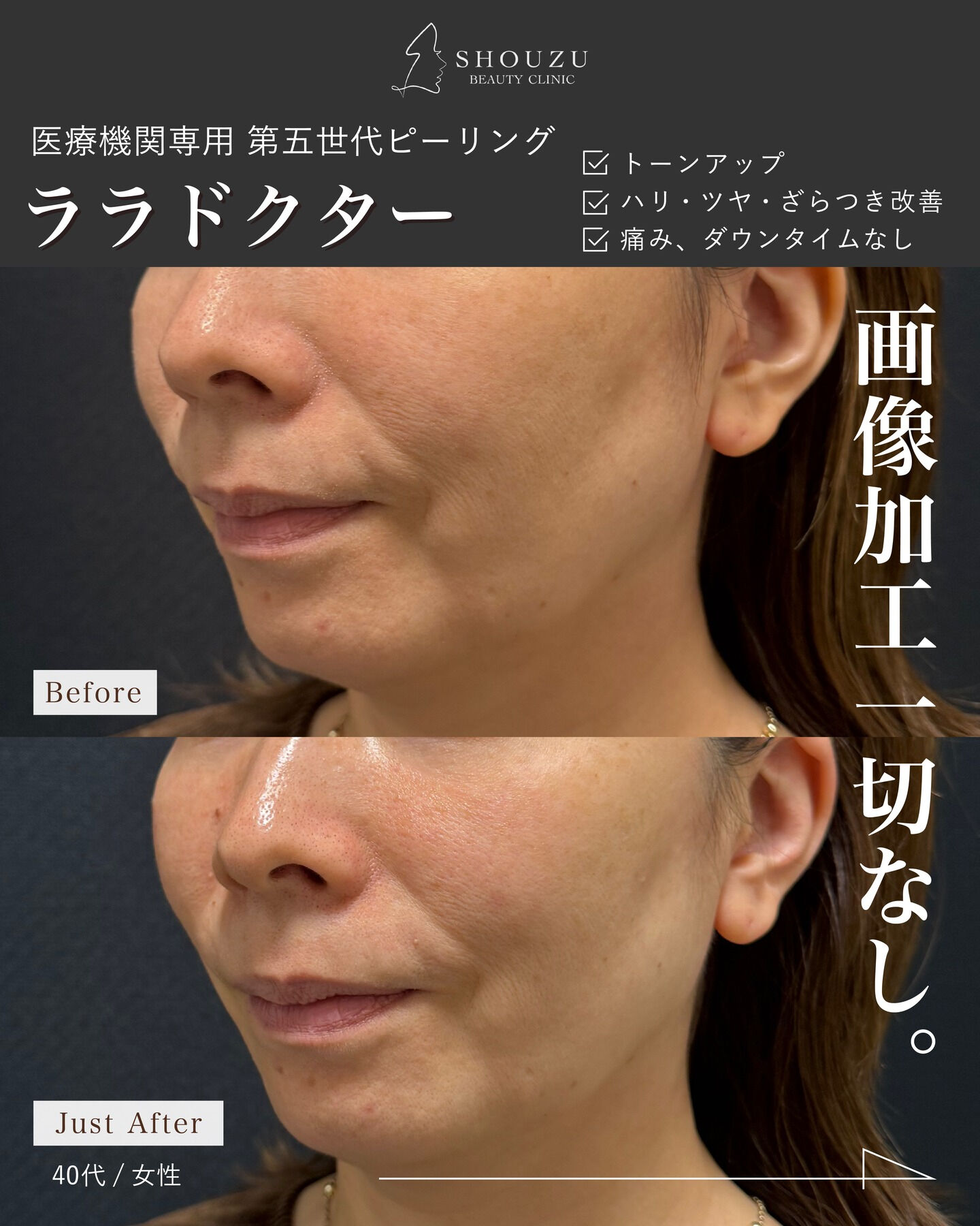 .大人気ピーリング
