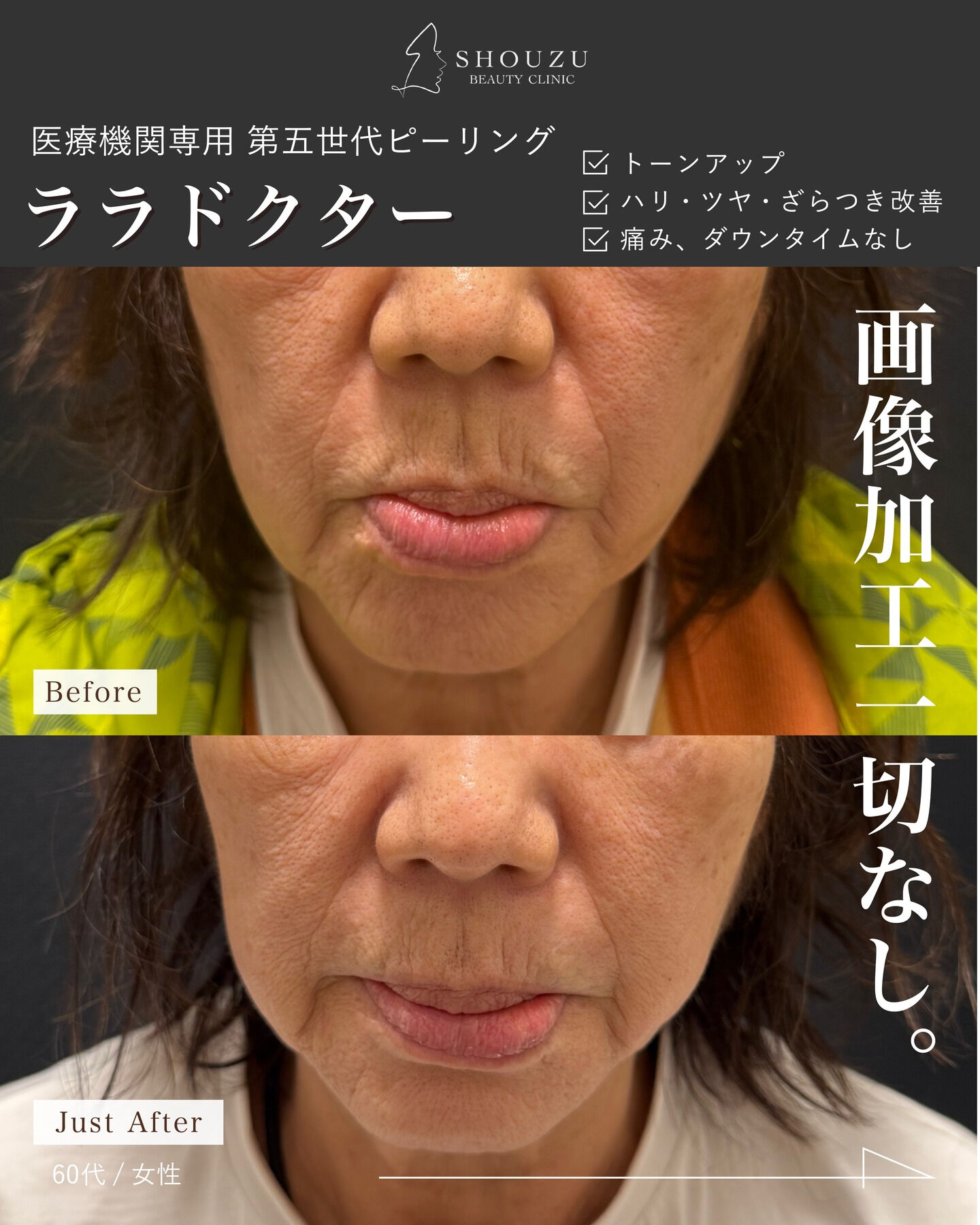 .大人気ピーリング