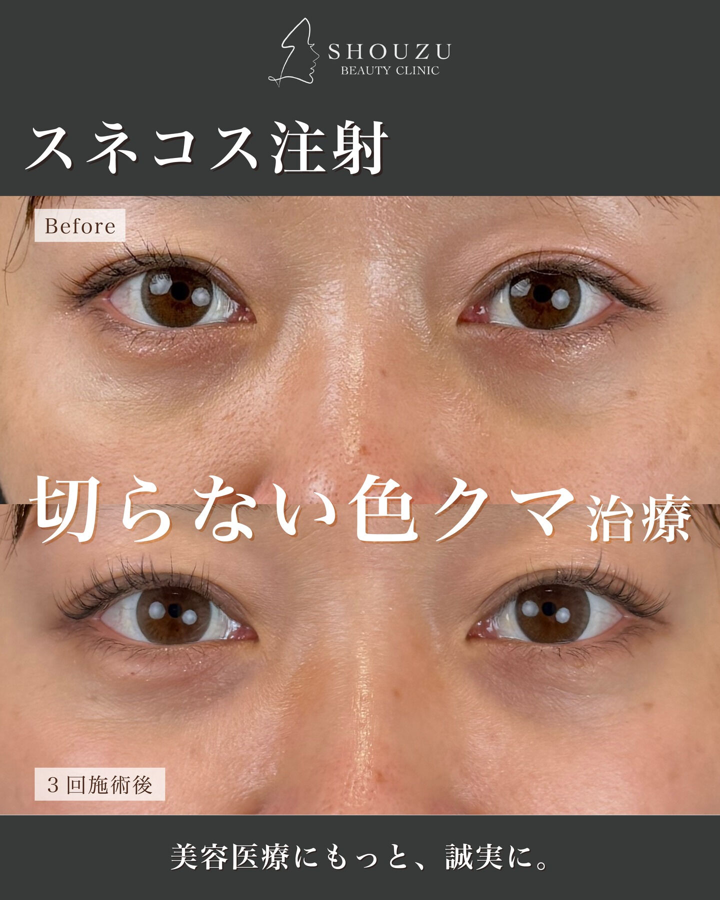 .30代のスタッフが、目元に3回スネコス注射を施術しました