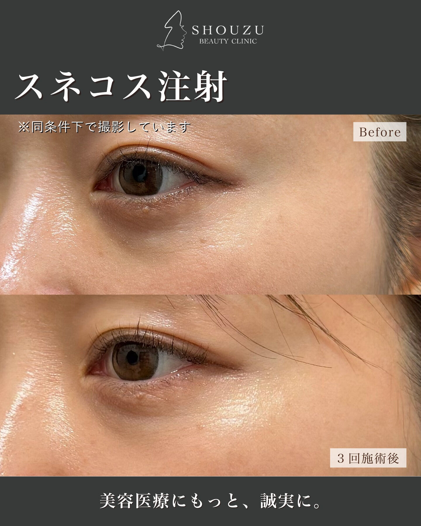 .30代のスタッフが、目元に3回スネコス注射を施術しました