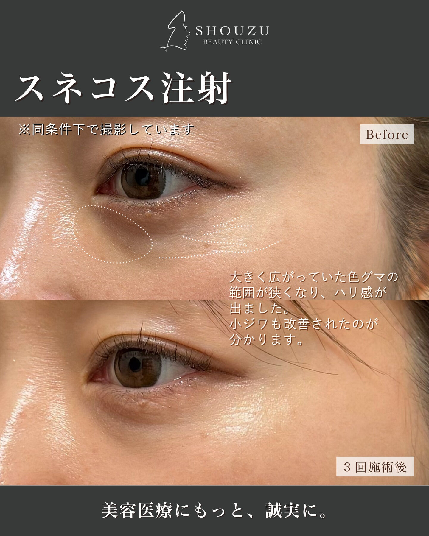 .30代のスタッフが、目元に3回スネコス注射を施術しました