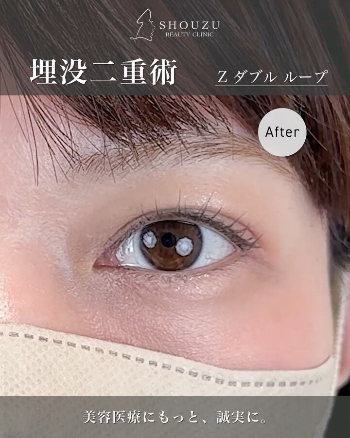 埋没二重術（Zダブルループ）