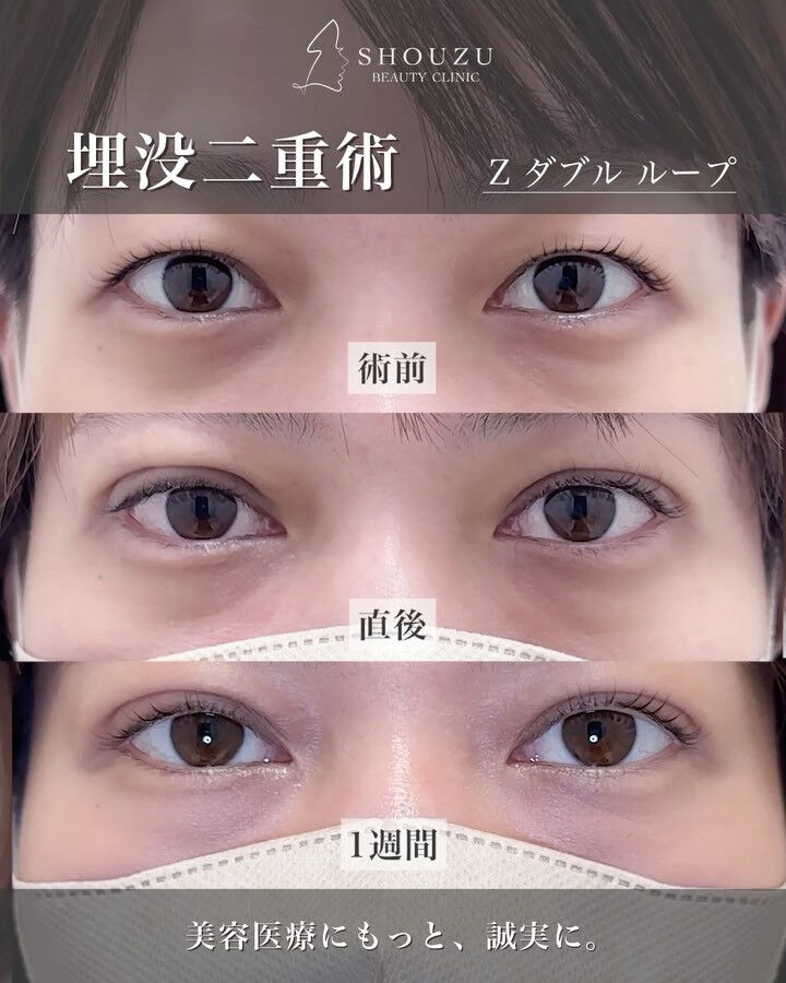 埋没二重術（Zダブルループ）