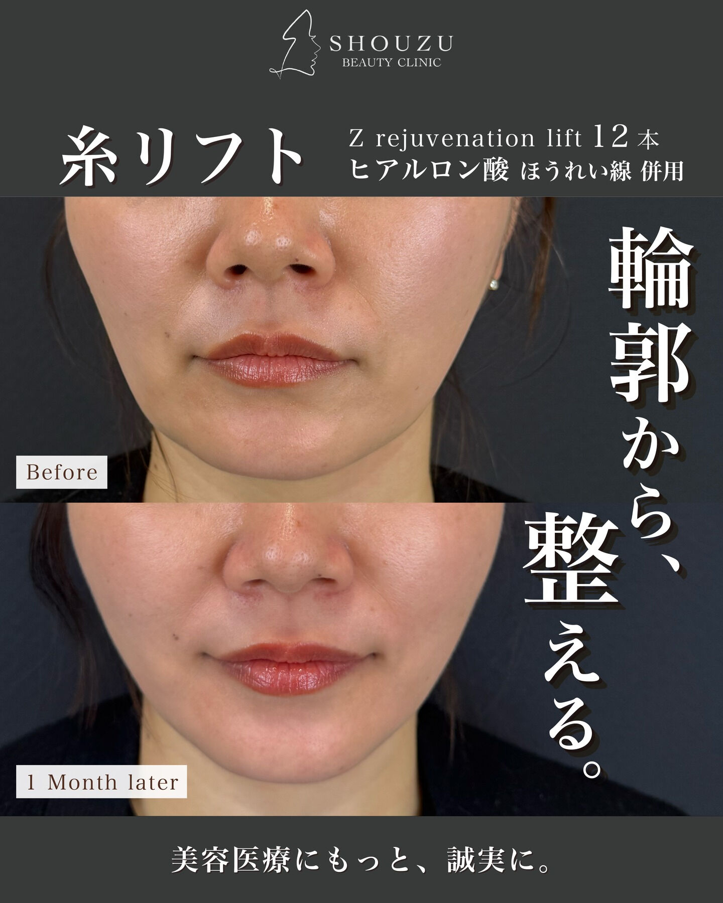 糸リフト