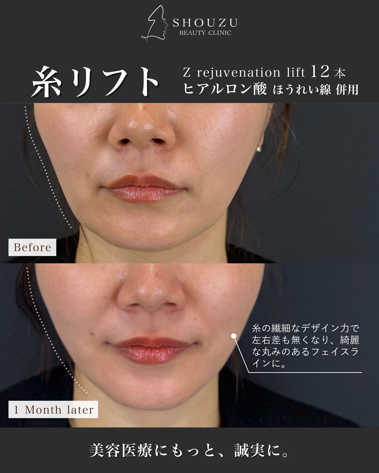 糸リフト