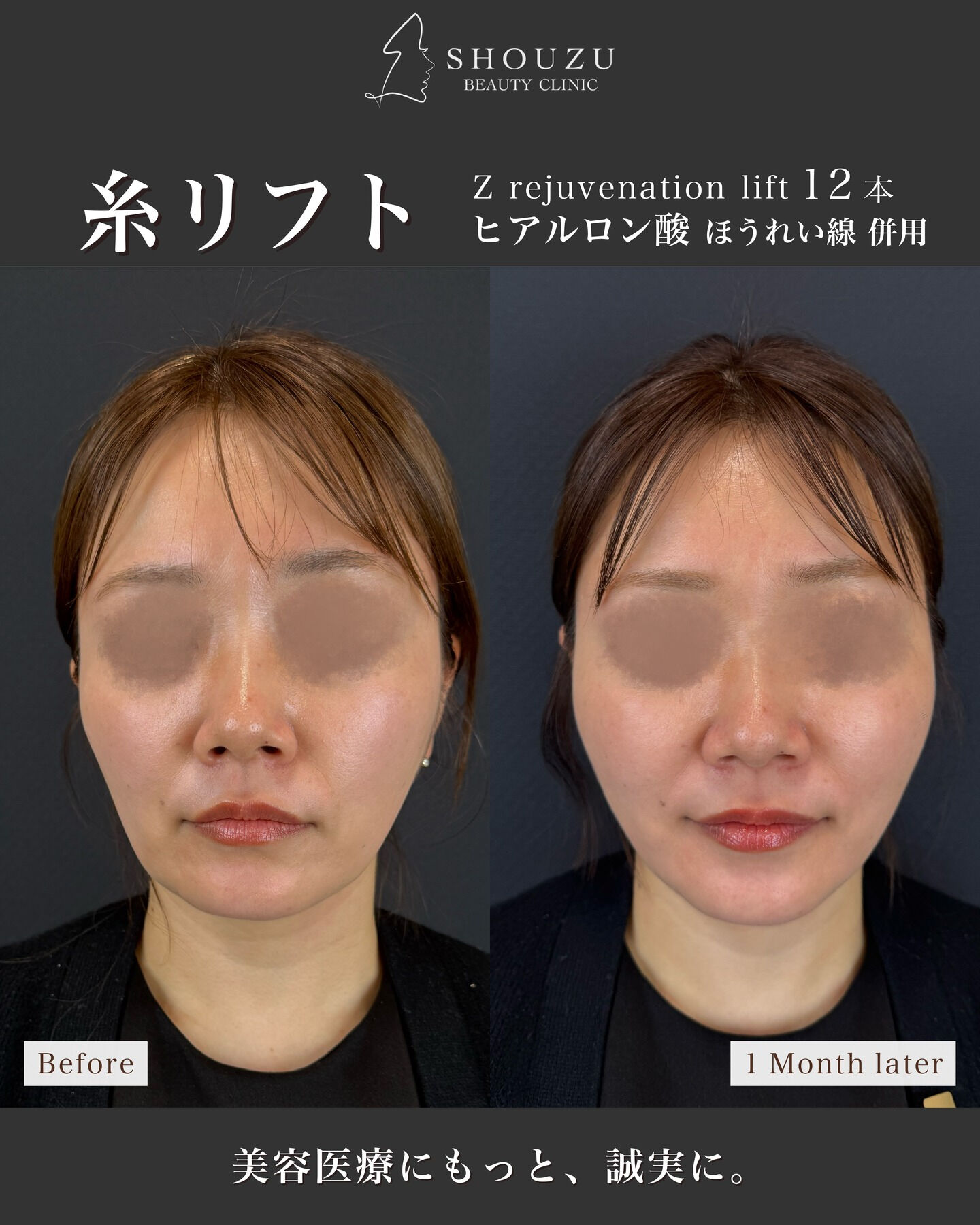 糸リフト