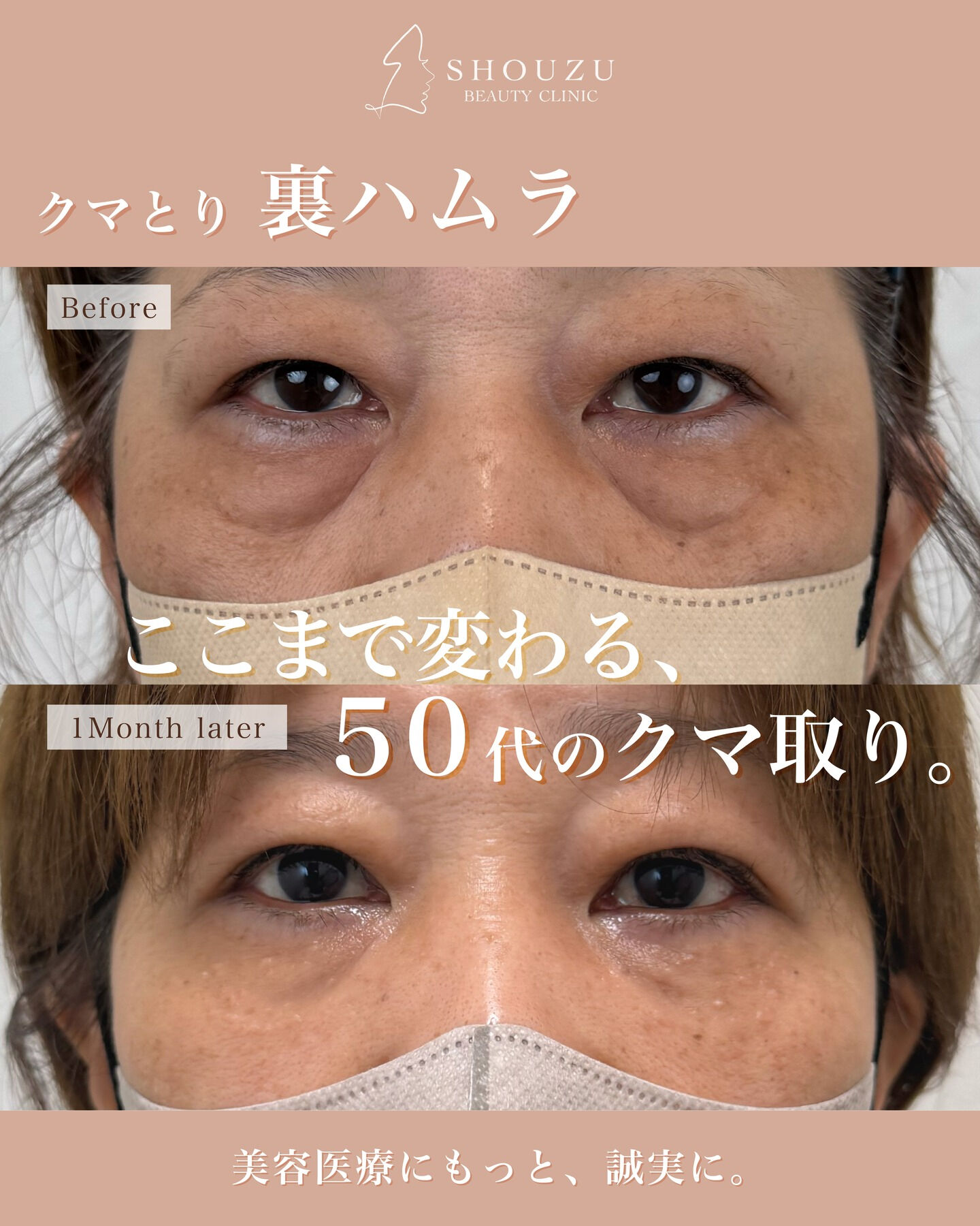 裏ハムラ法