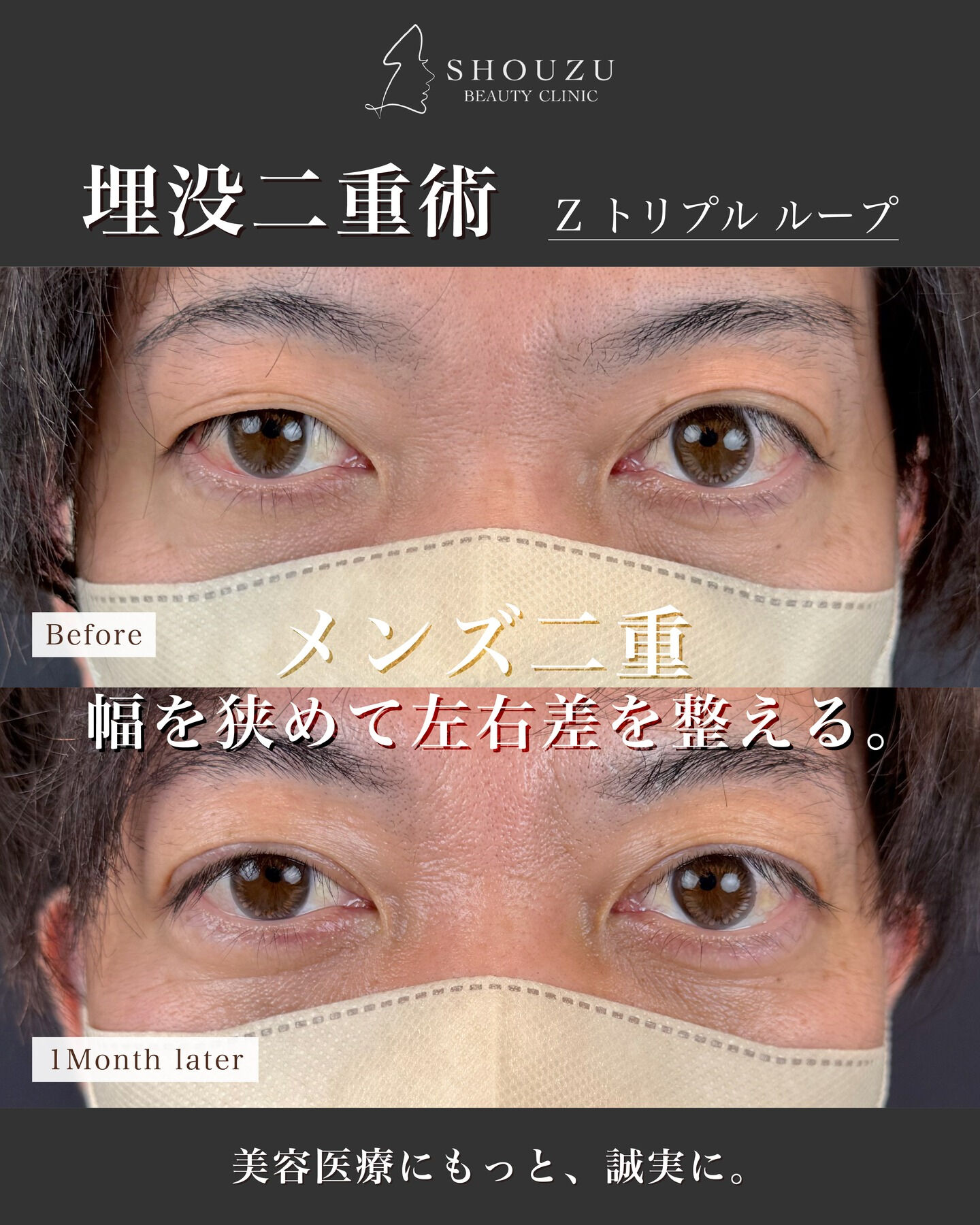 埋没二重術（Zトリプルループ）