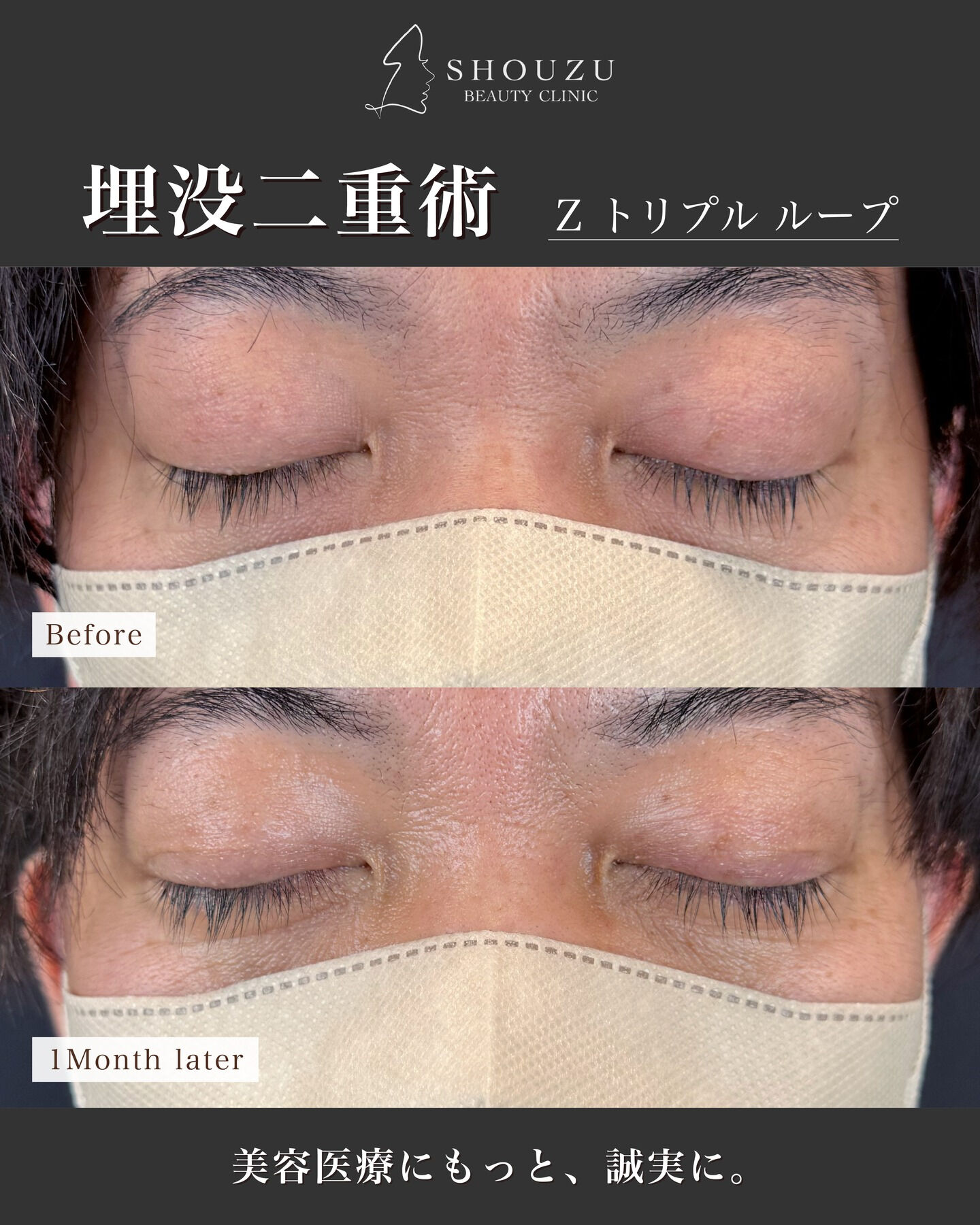 埋没二重術（Zトリプルループ）