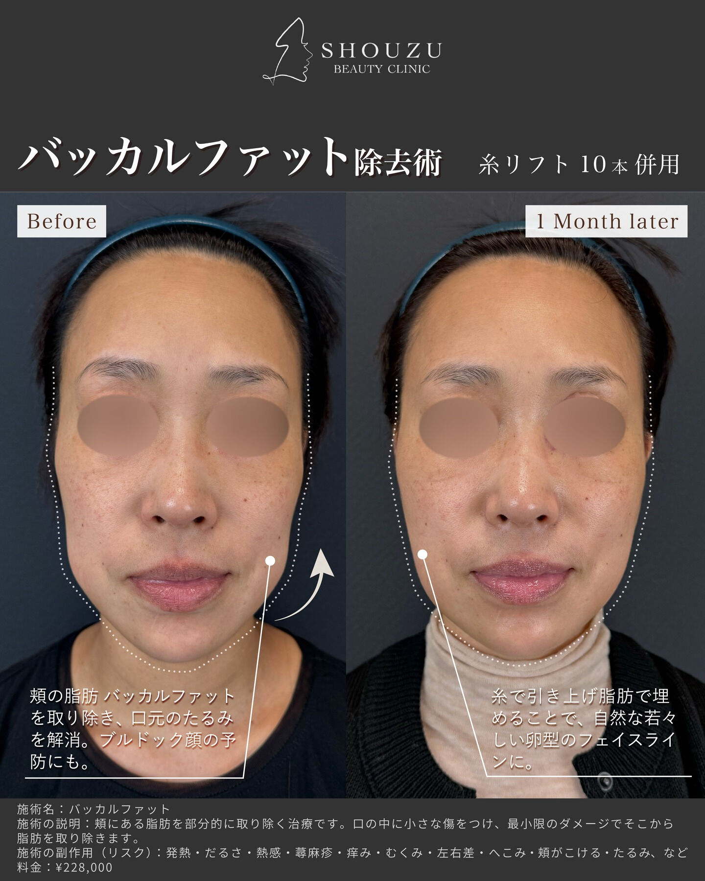 バッカルファット＋糸リフト