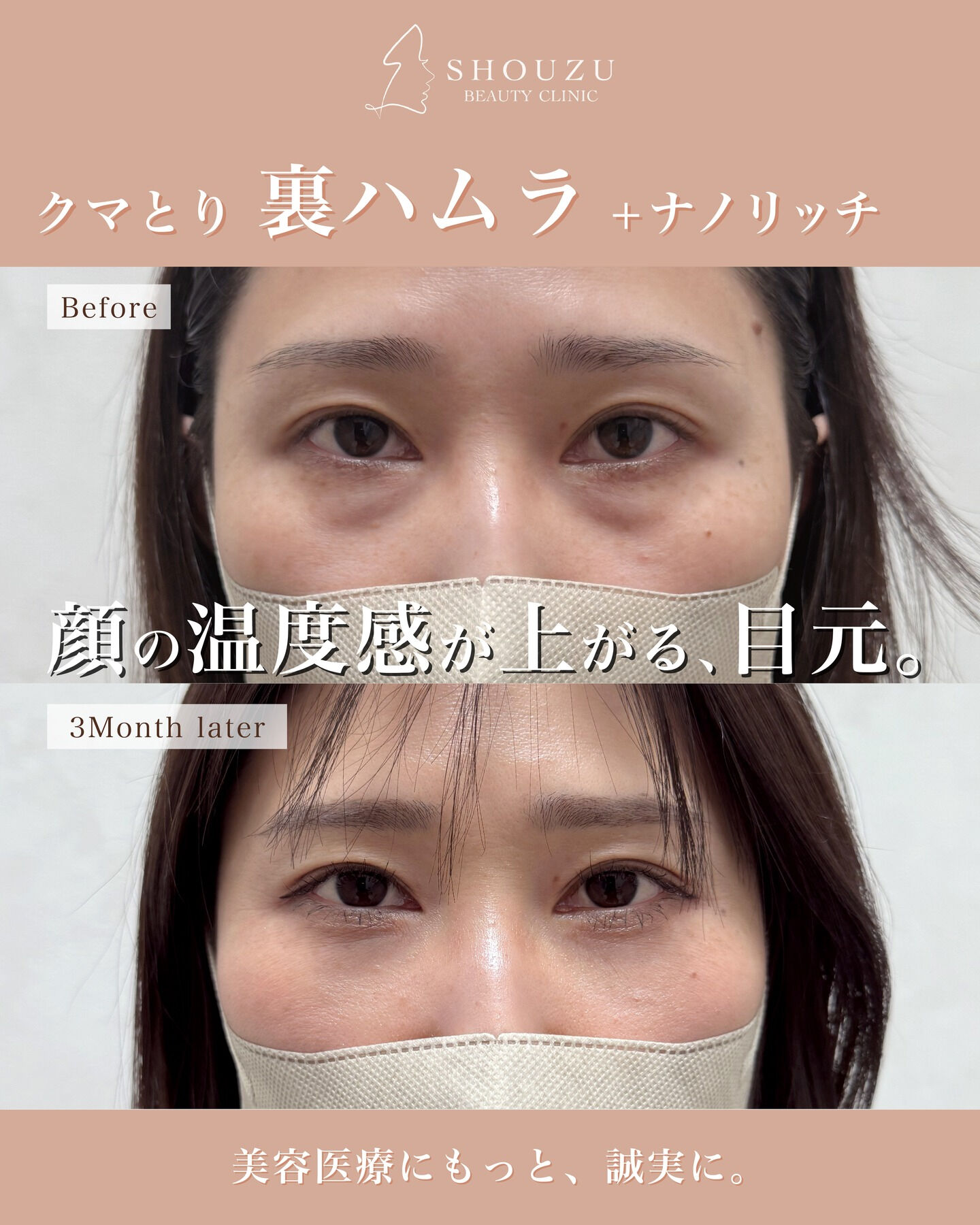 クマ取り施術　 裏ハムラ法＋ナノリッチ
