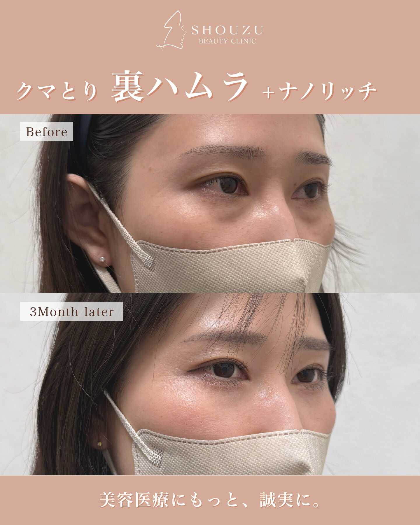 クマ取り施術　 裏ハムラ法＋ナノリッチ