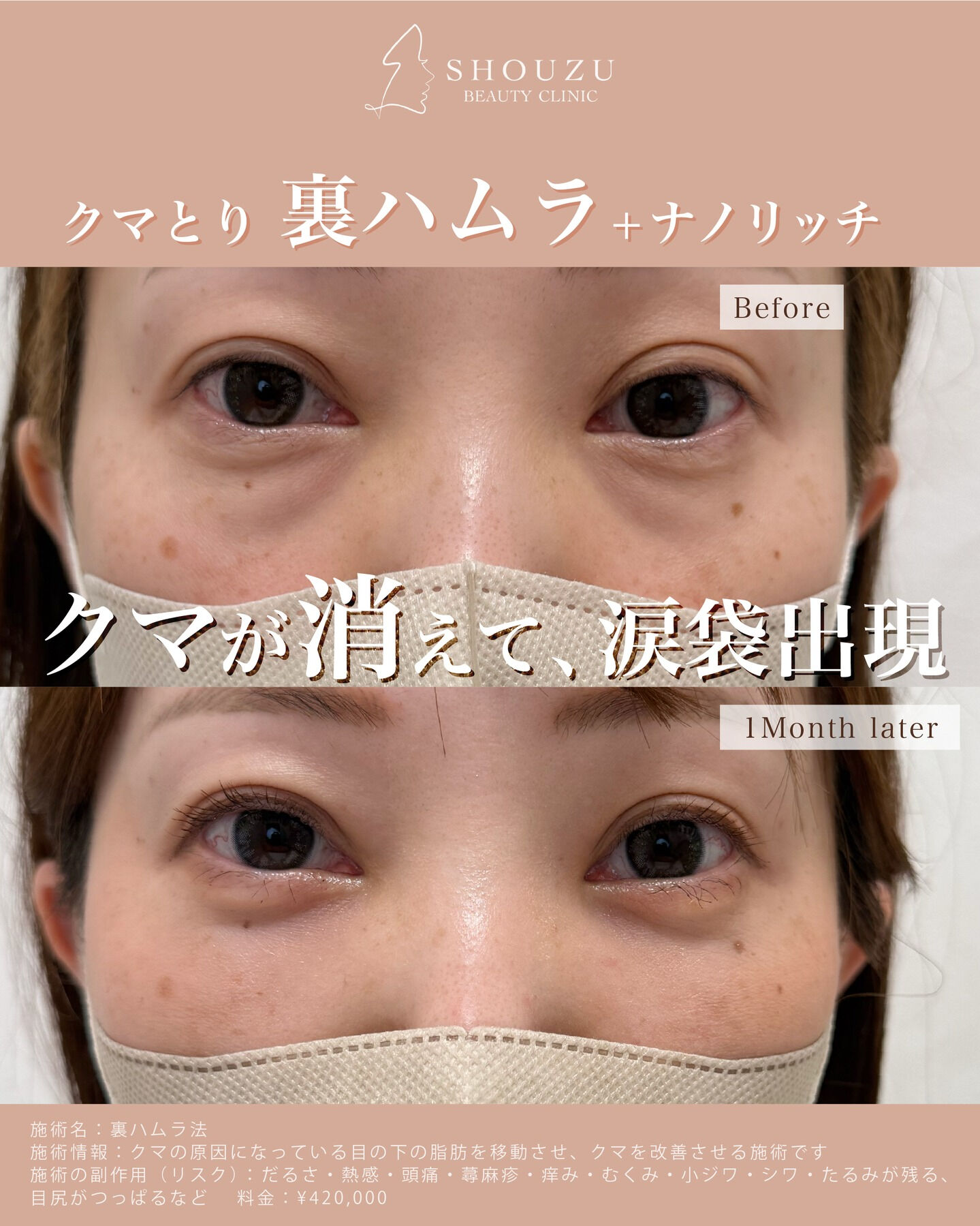 クマ取り施術 裏ハムラ法＋ナノリッチ