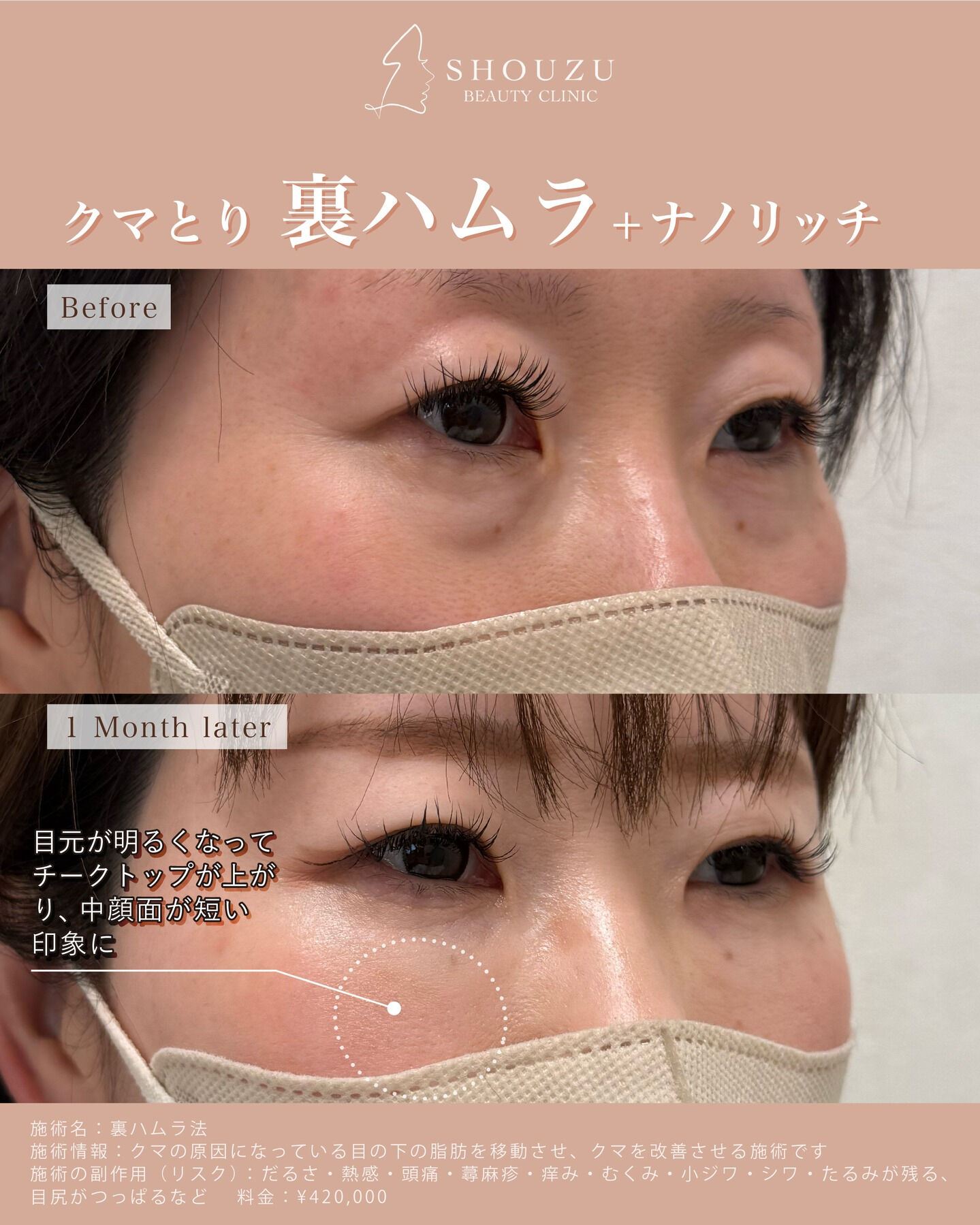 クマ取り施術 　裏ハムラ法＋ナノリッチ