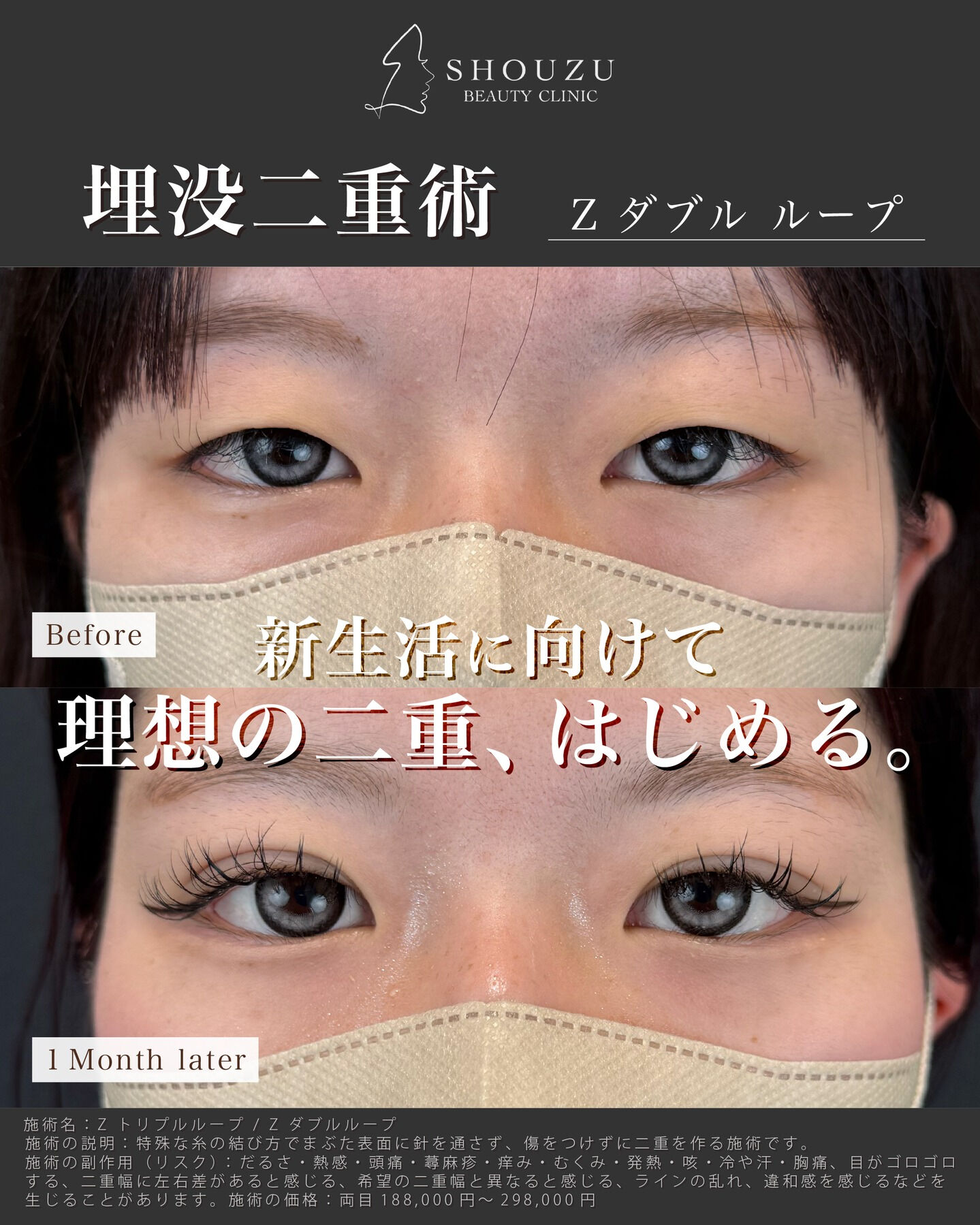 埋没二重術 Z ダブル ループ