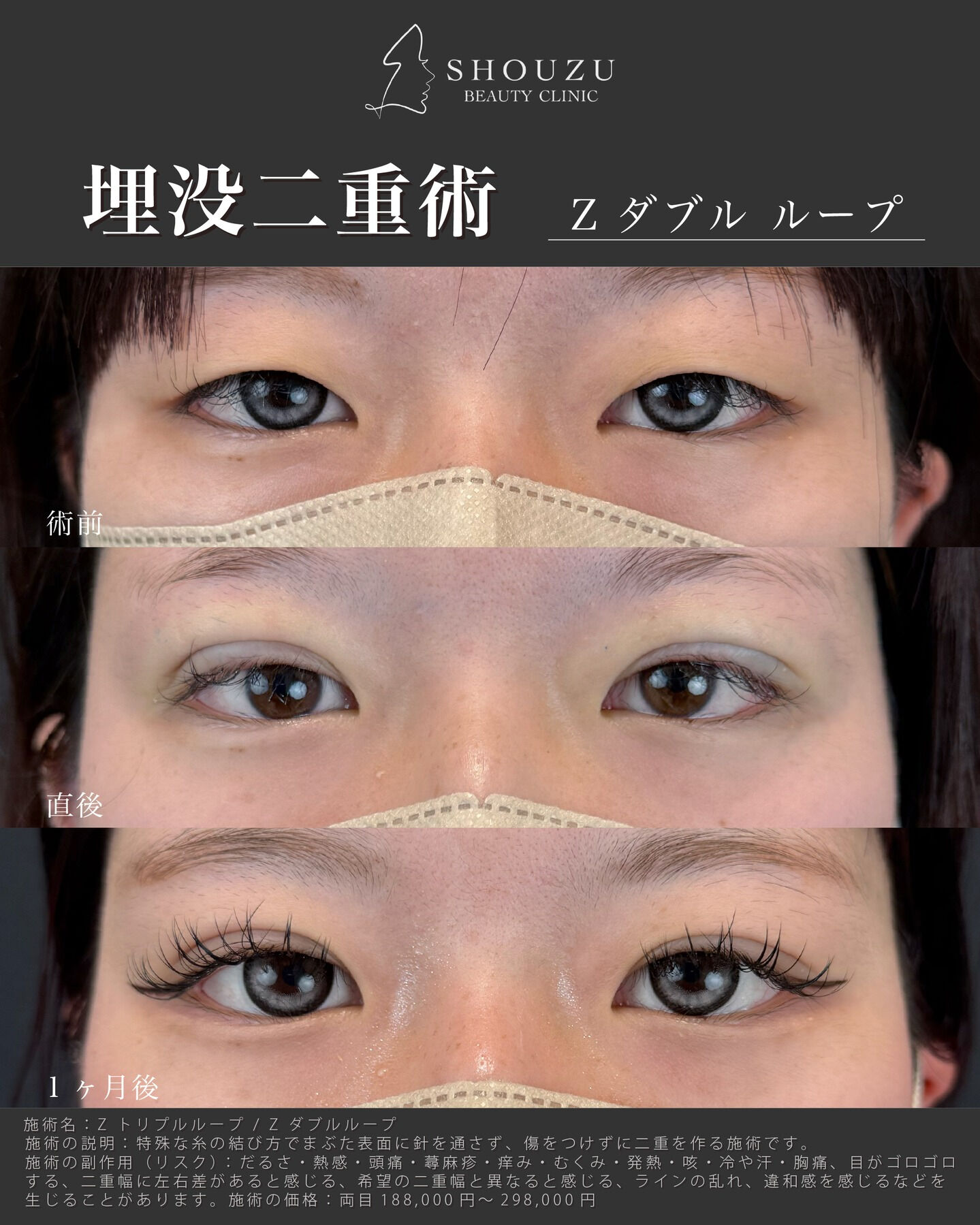 埋没二重術 Z ダブル ループ