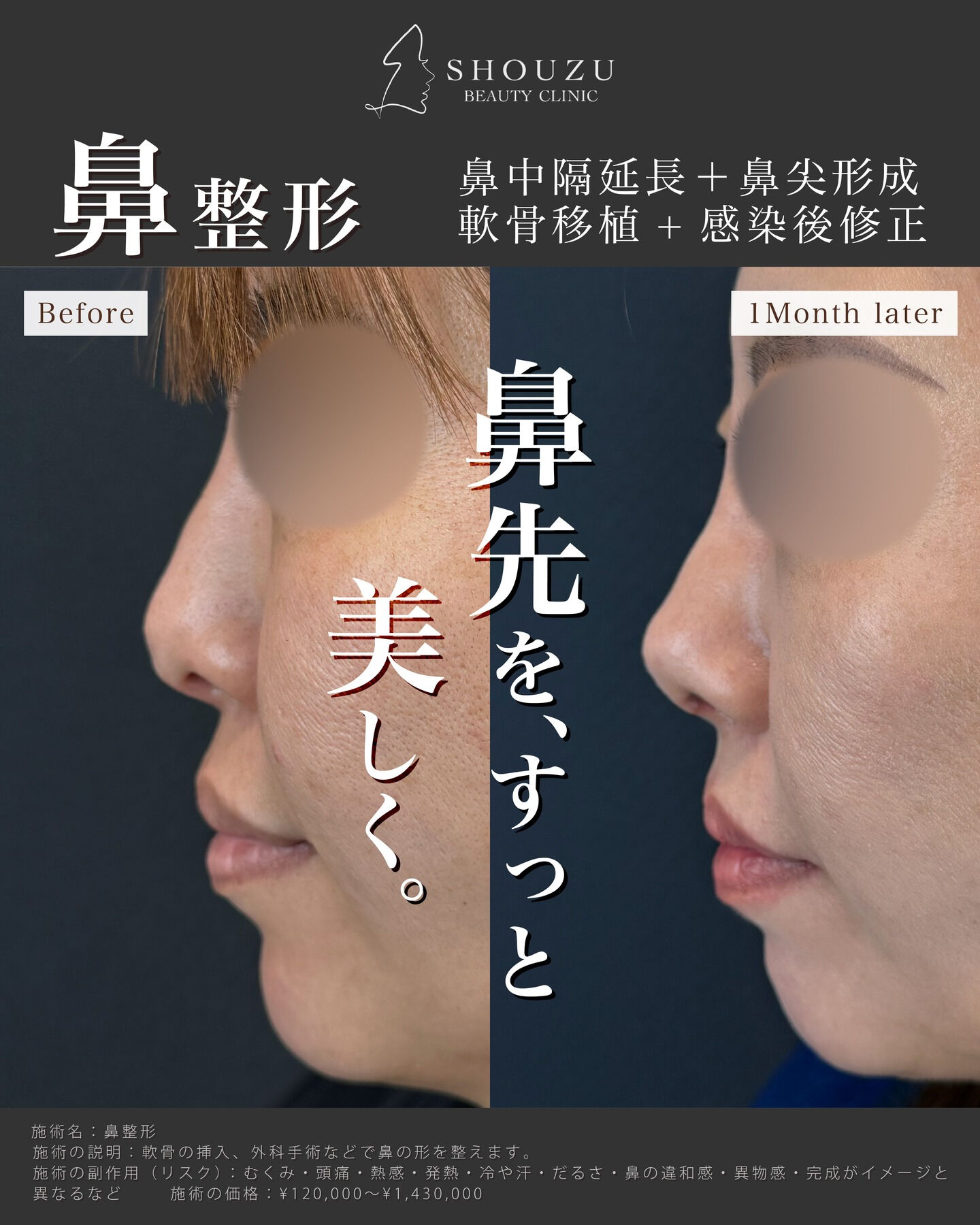 鼻中隔延長＋鼻尖形成+軟骨移植+感染後修正