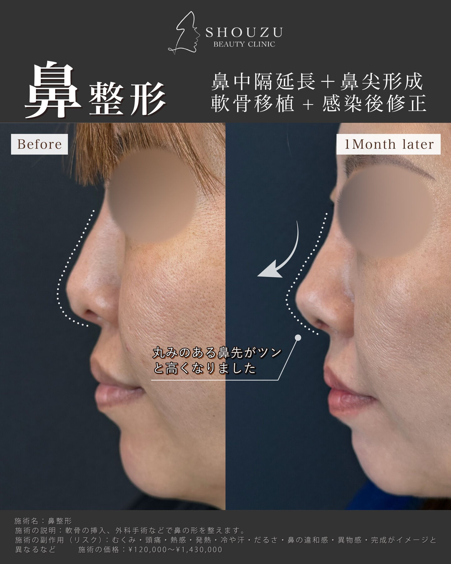 鼻中隔延長＋鼻尖形成+軟骨移植+感染後修正
