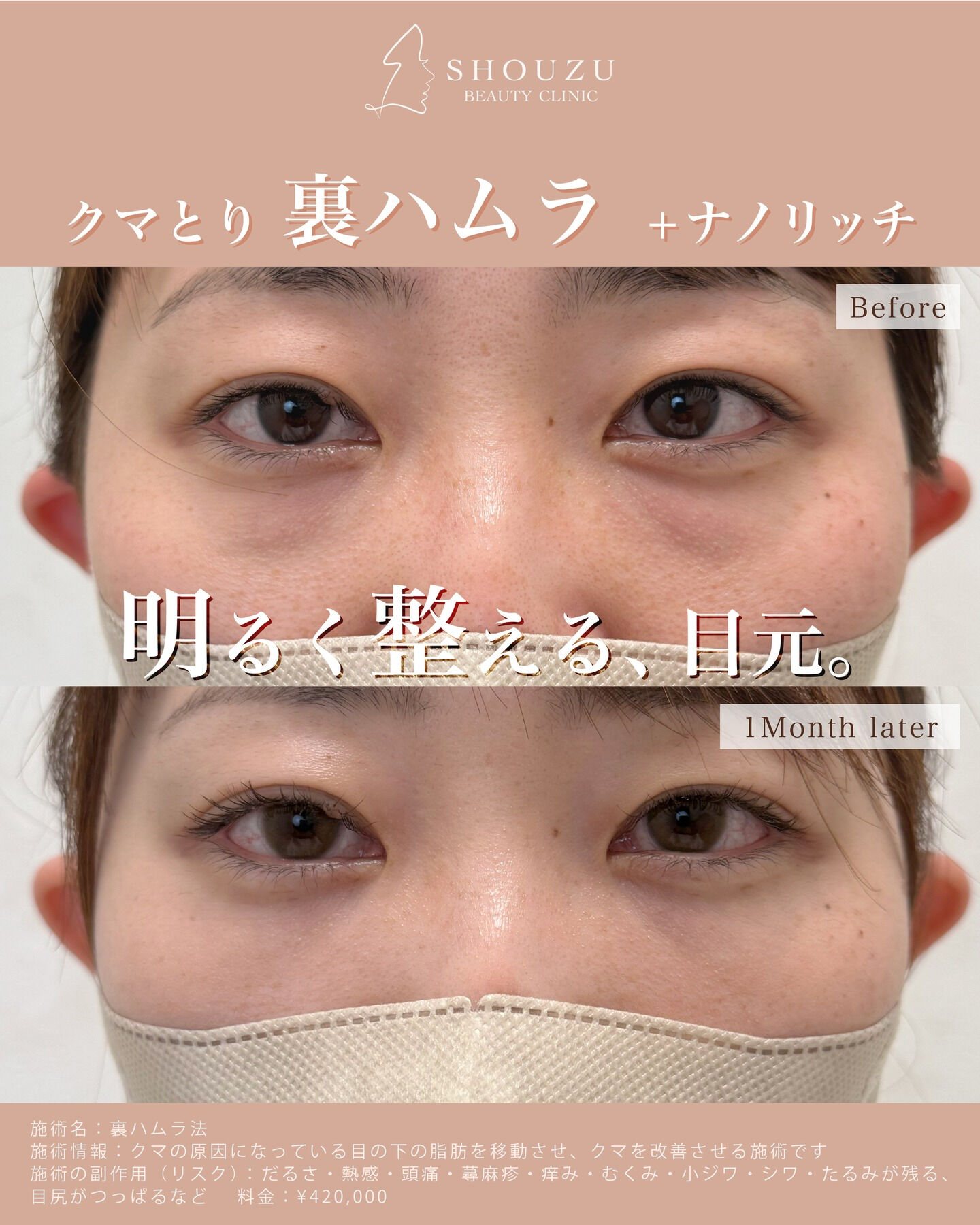 クマ取り施術 裏ハムラ法＋ナノリッチ