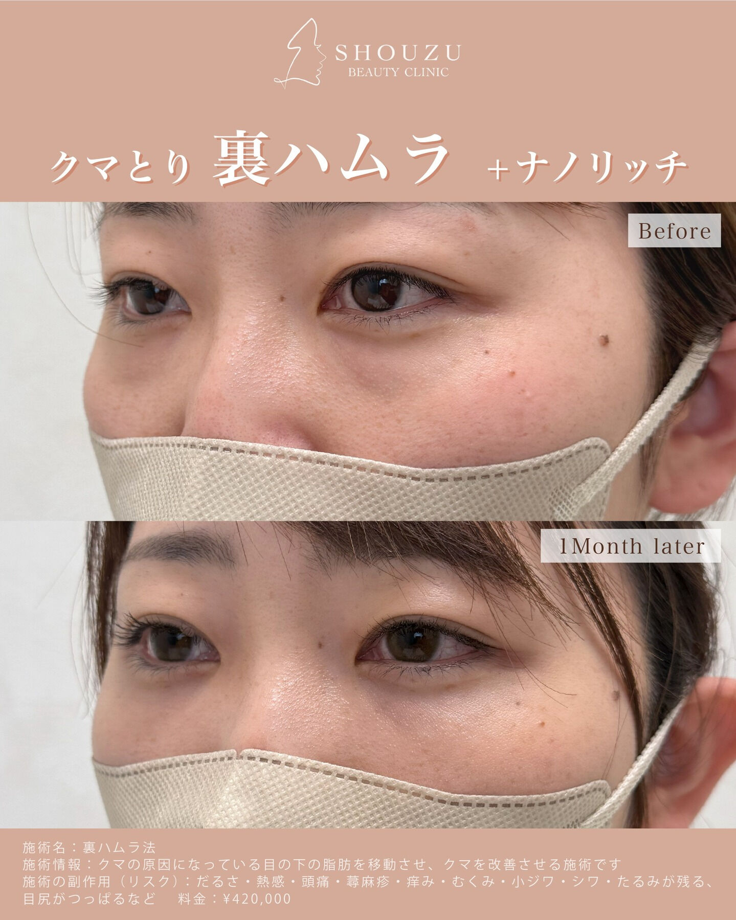 クマ取り施術 裏ハムラ法＋ナノリッチ