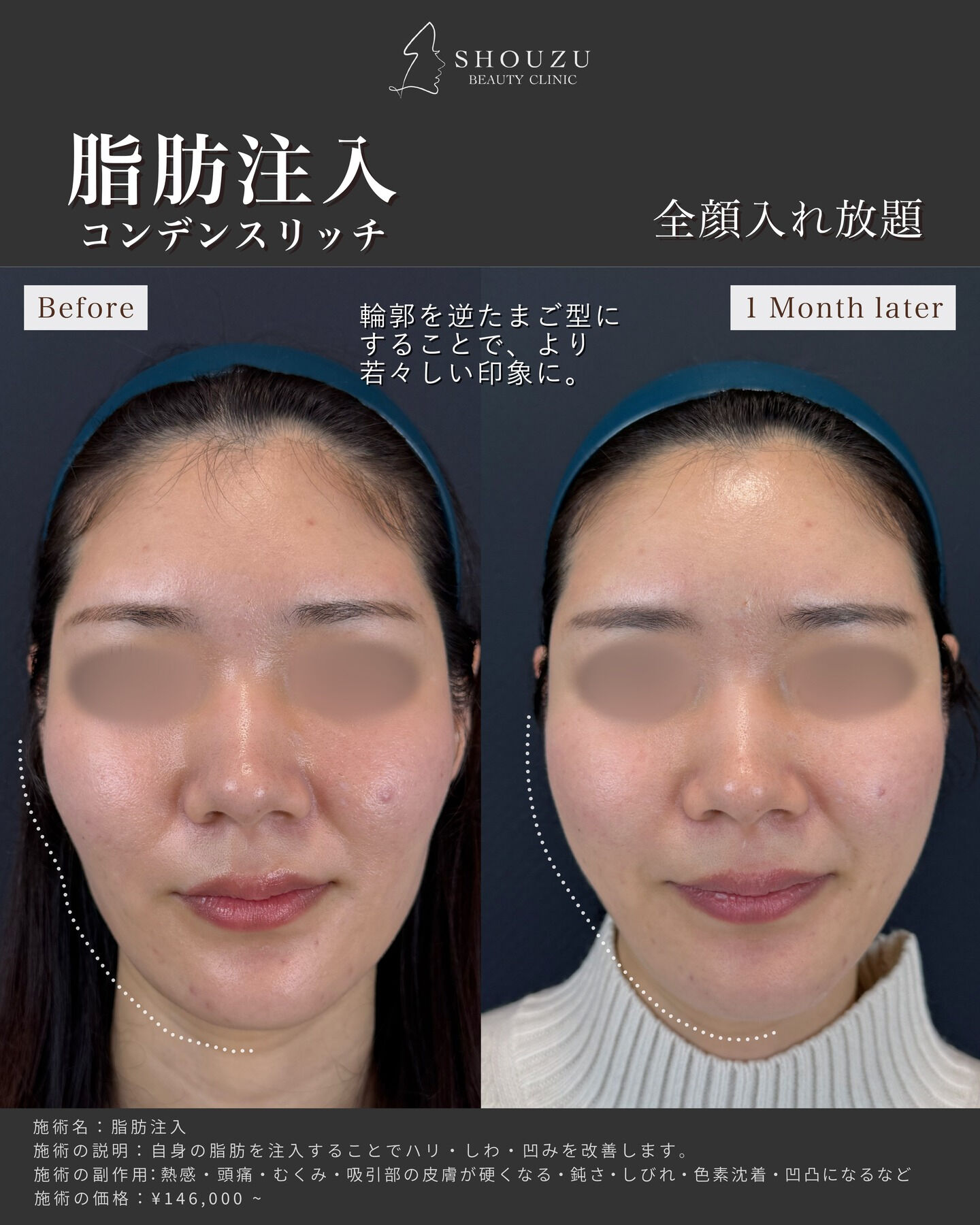 脂肪注入