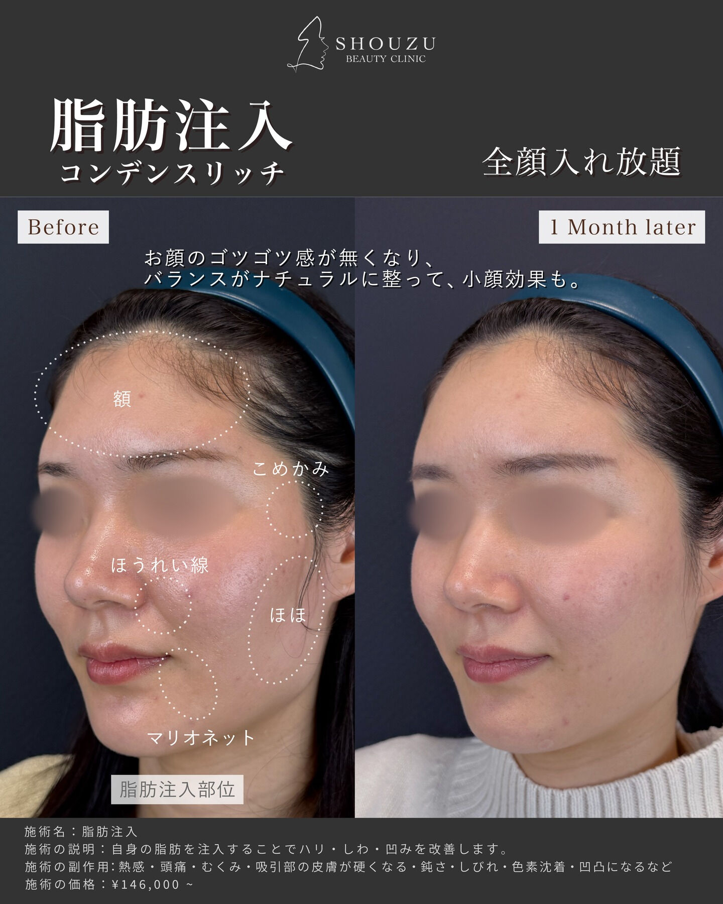 脂肪注入