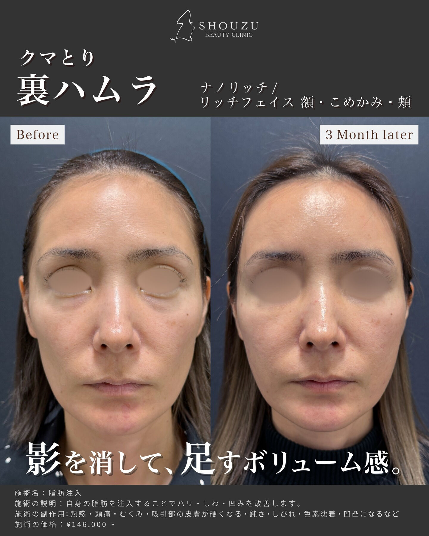 クマ取り施術 裏ハムラ法
