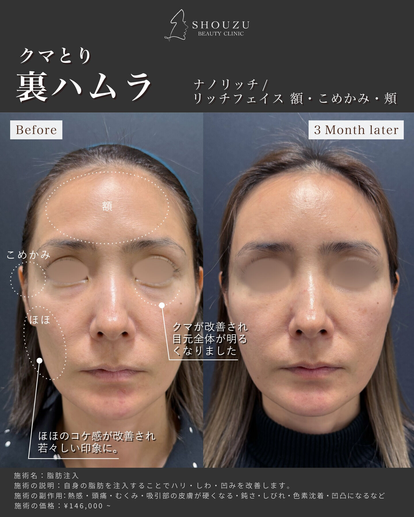 クマ取り施術 裏ハムラ法