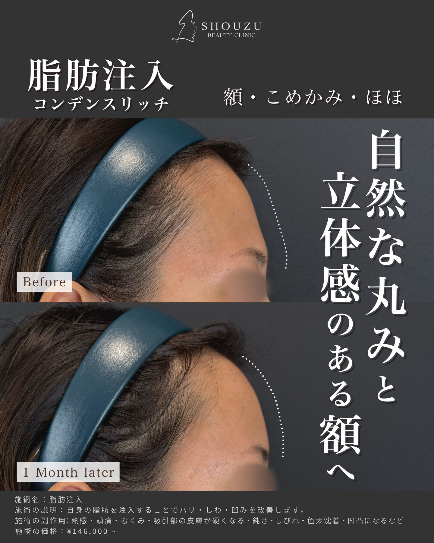 脂肪注入 入れ放題