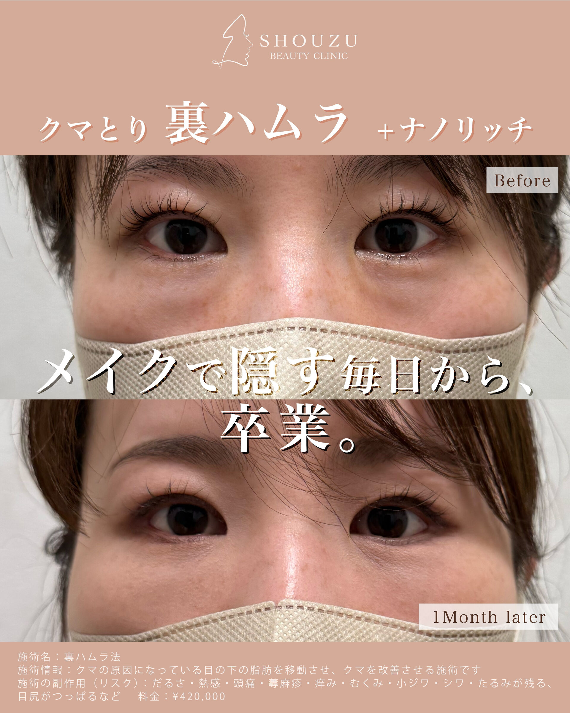 裏ハムラ法