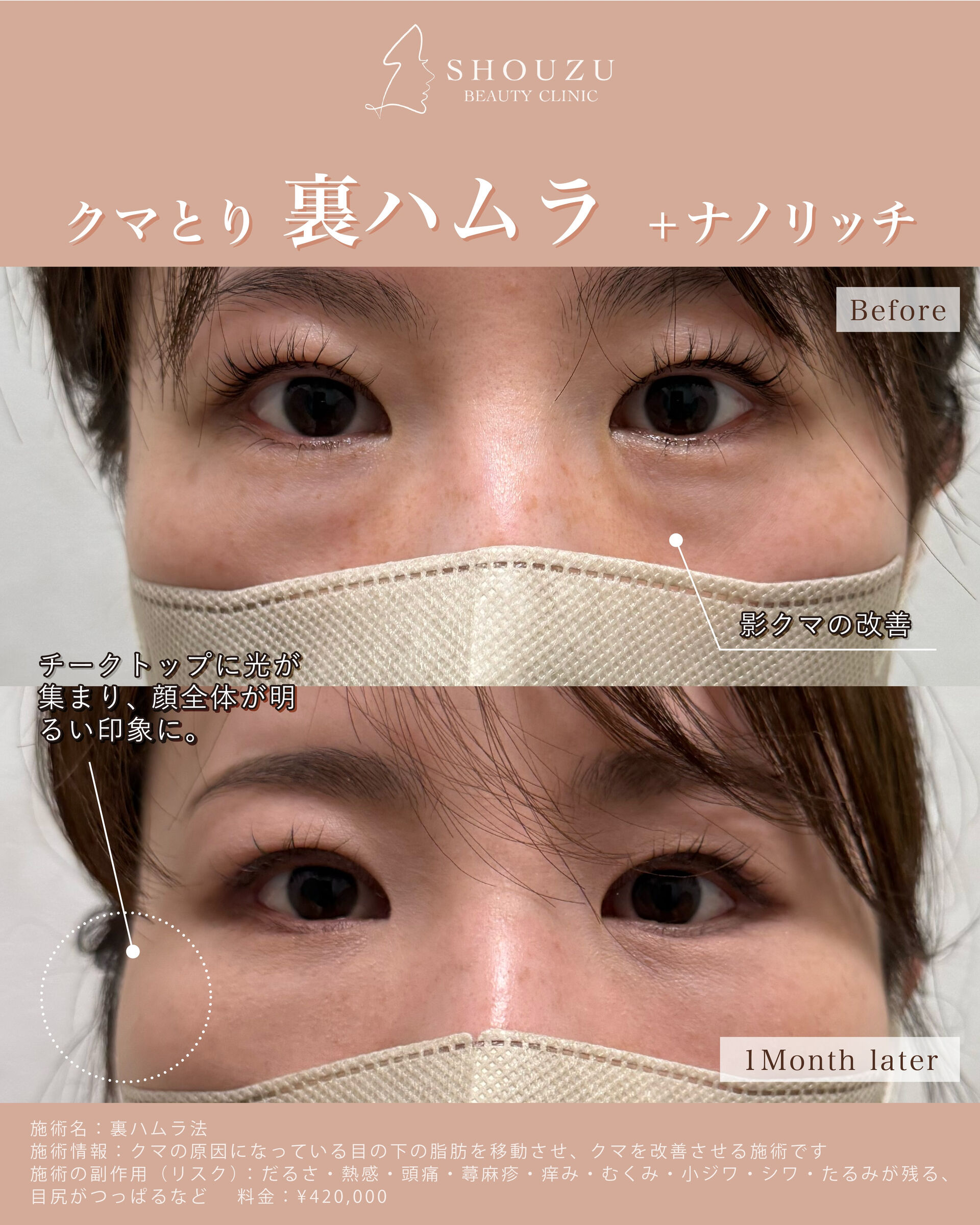 裏ハムラ法