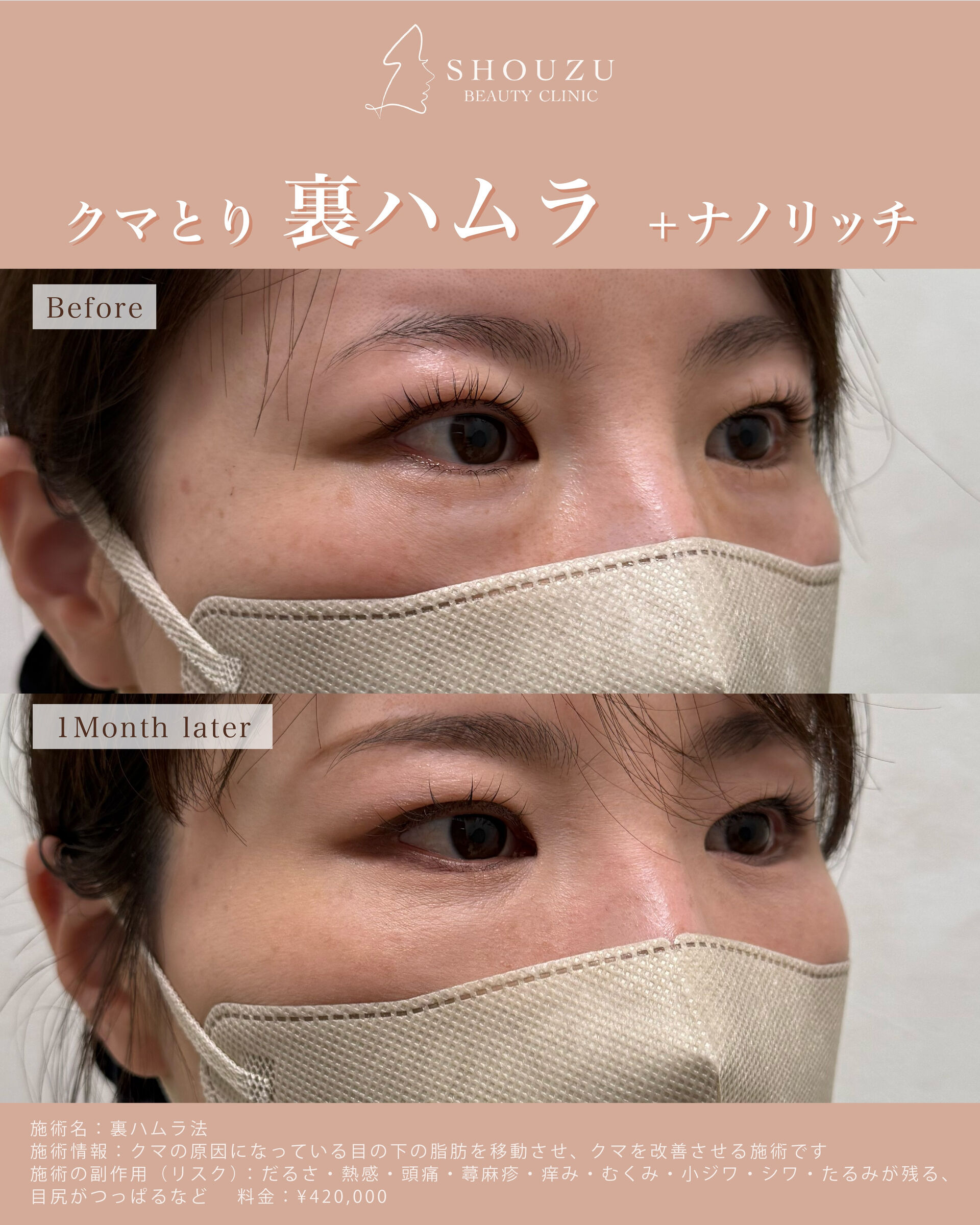 裏ハムラ法