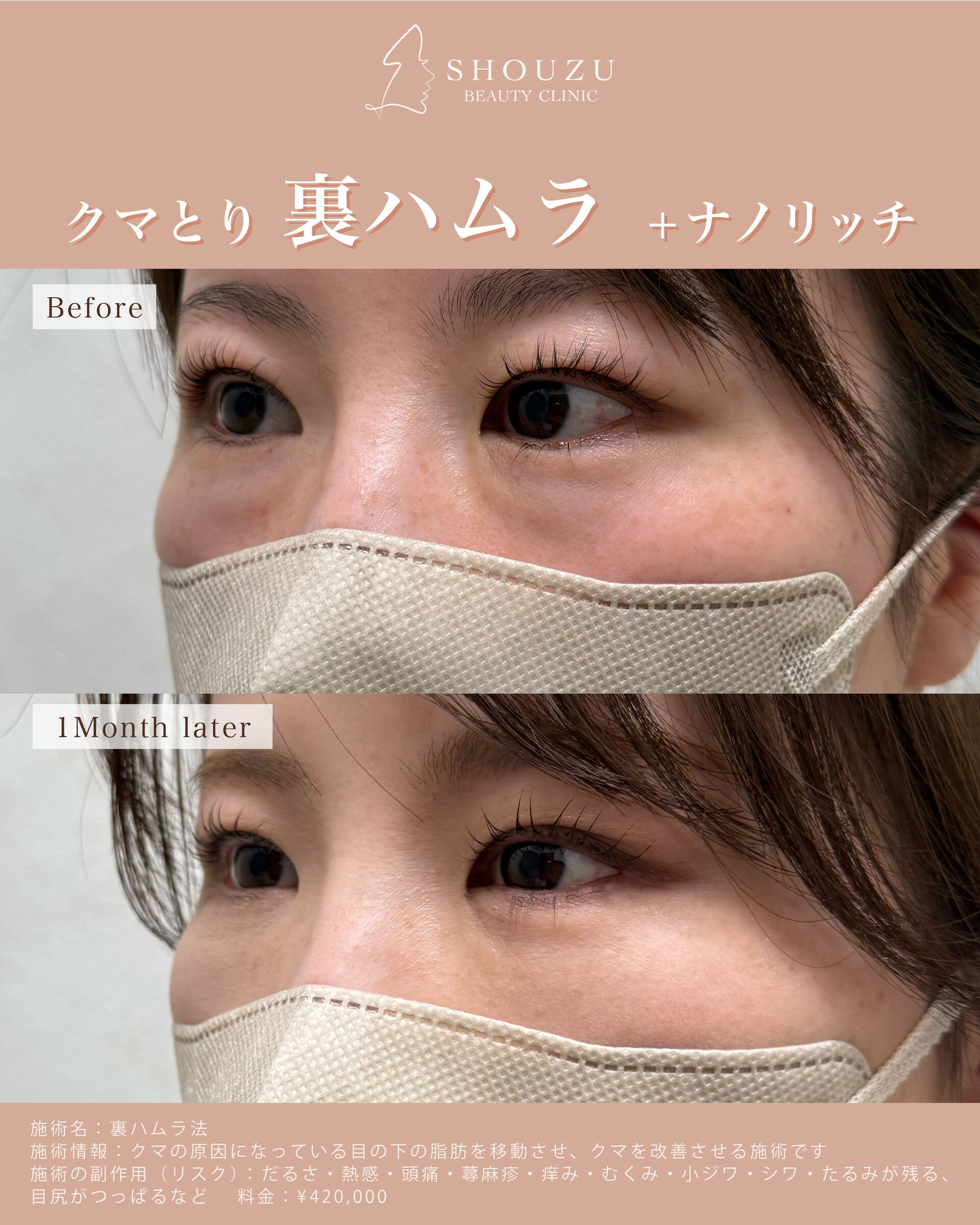 裏ハムラ法