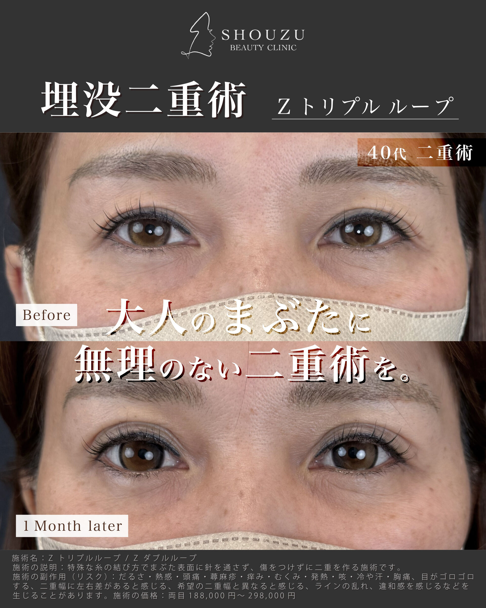 埋没二重術 Z トリプルループ