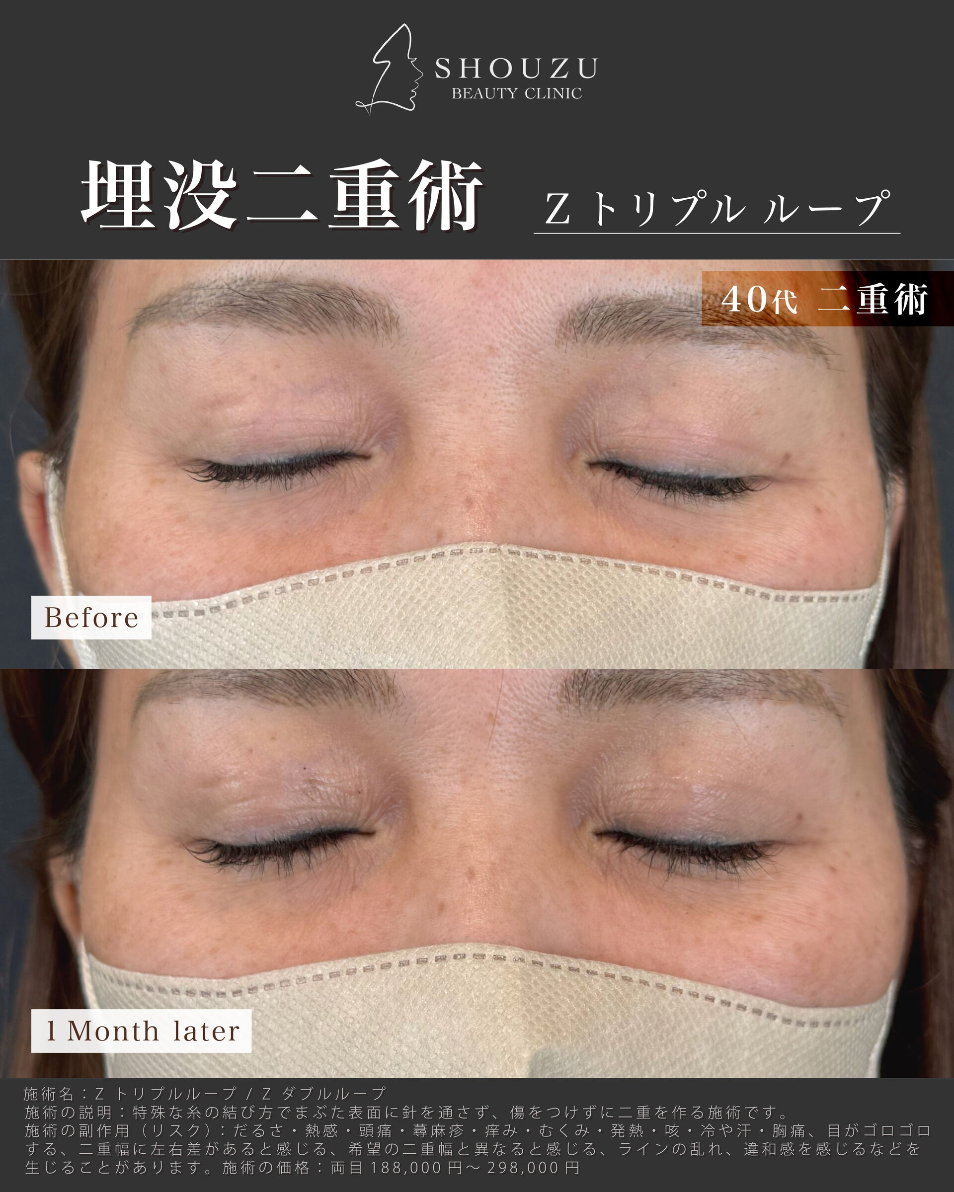 埋没二重術 Z トリプルループ
