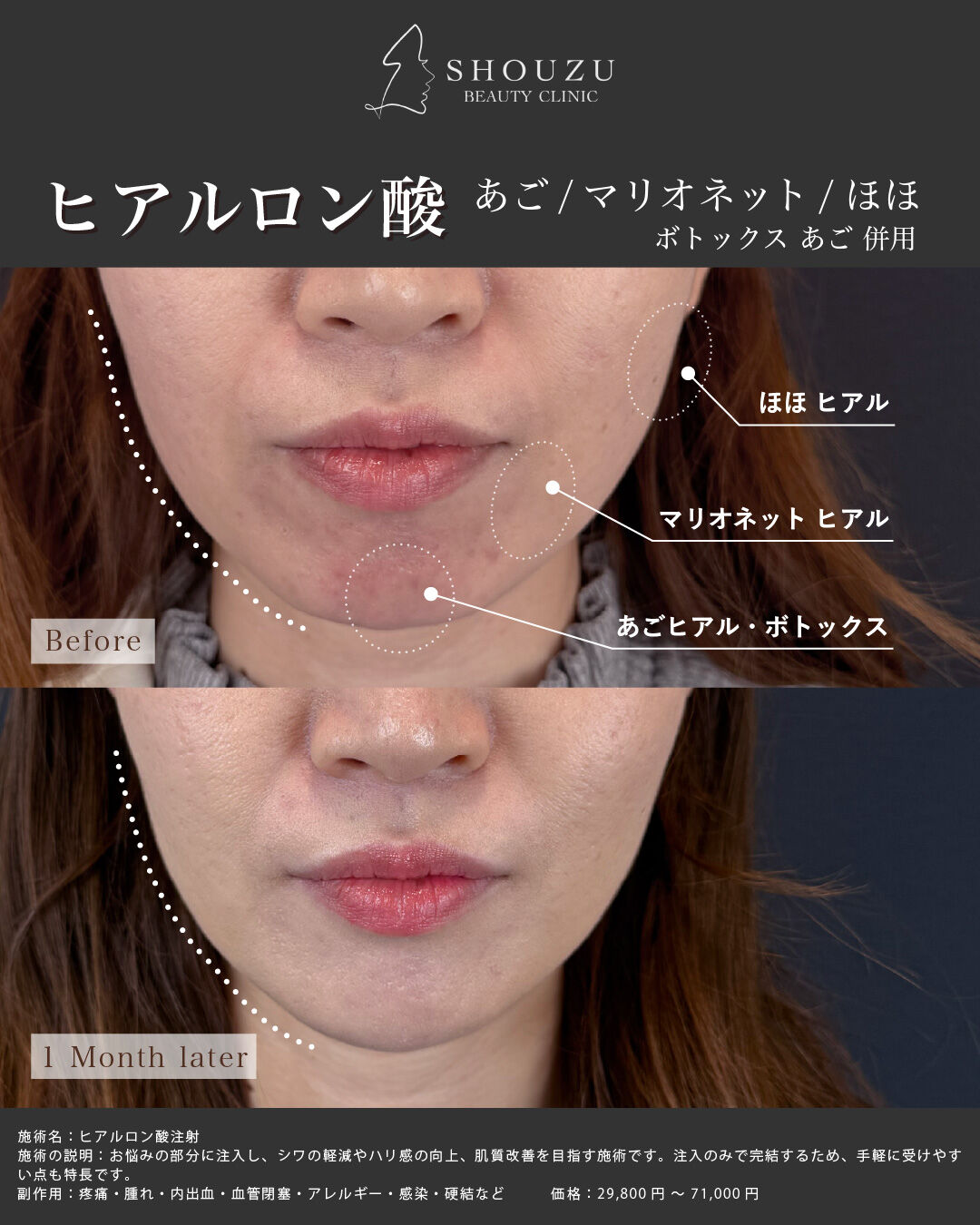 ヒアルロン酸