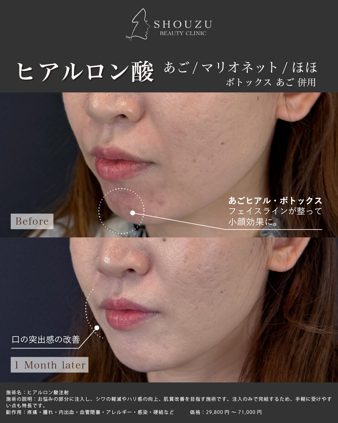 ヒアルロン酸