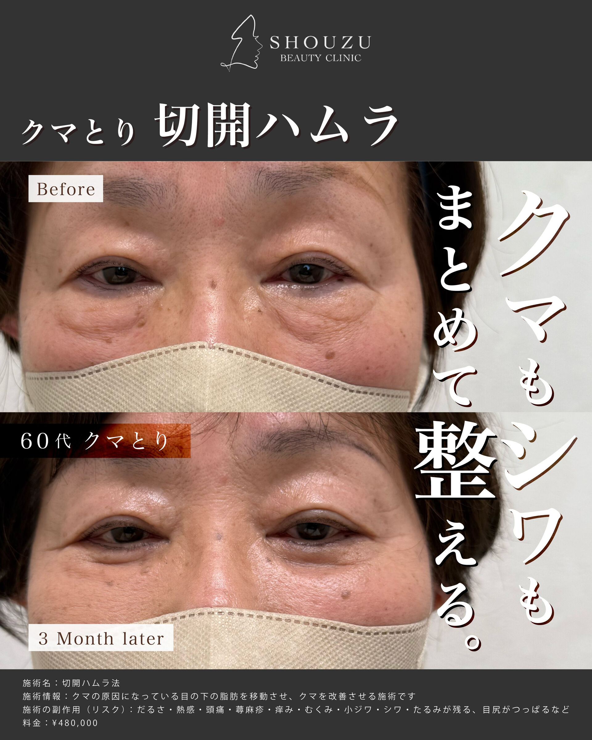 クマ取り施術 切開ハムラ法