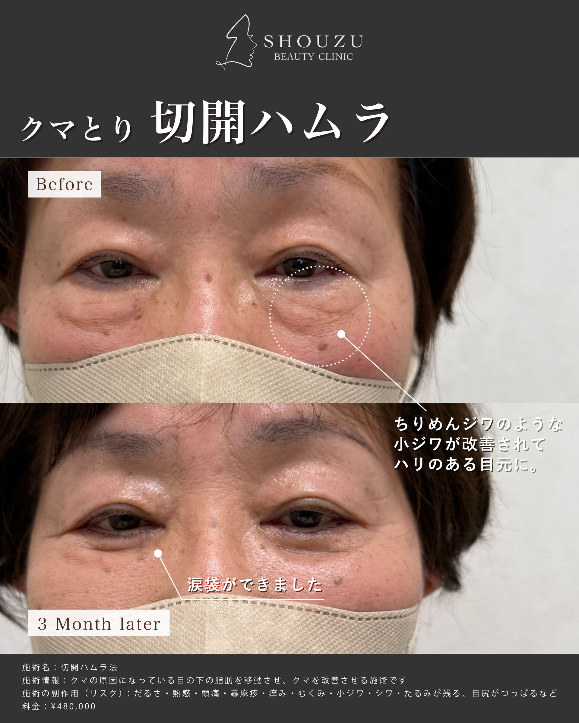 クマ取り施術 切開ハムラ法