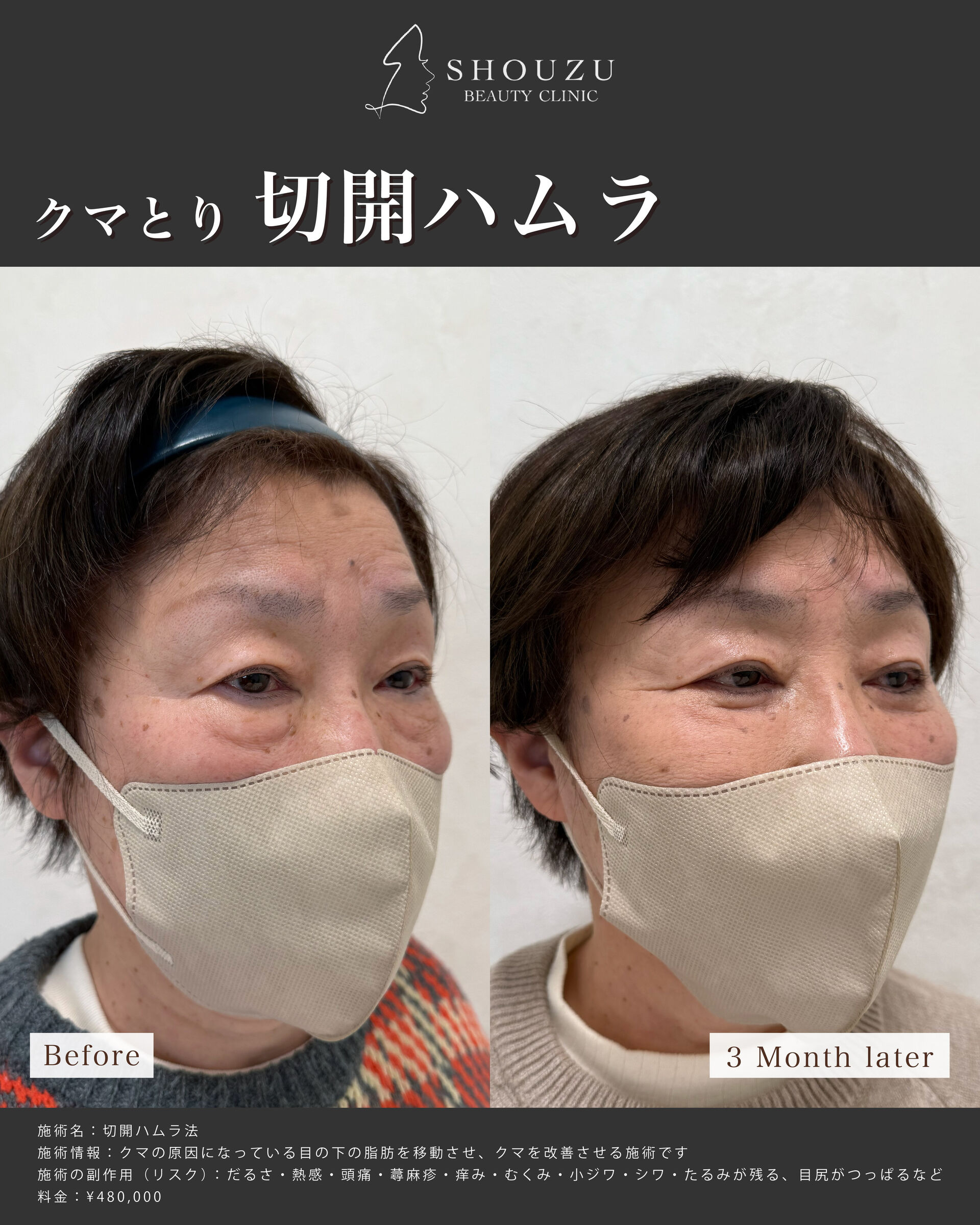 クマ取り施術 切開ハムラ法
