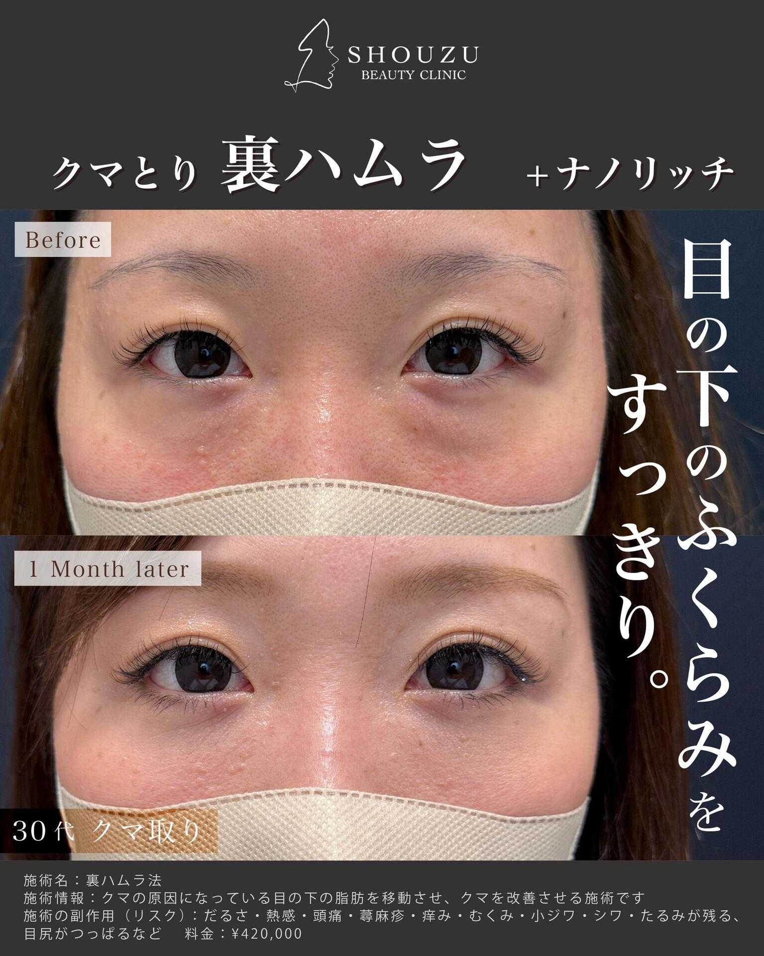 クマ取り施術 裏ハムラ法とナノリッチを施術されました