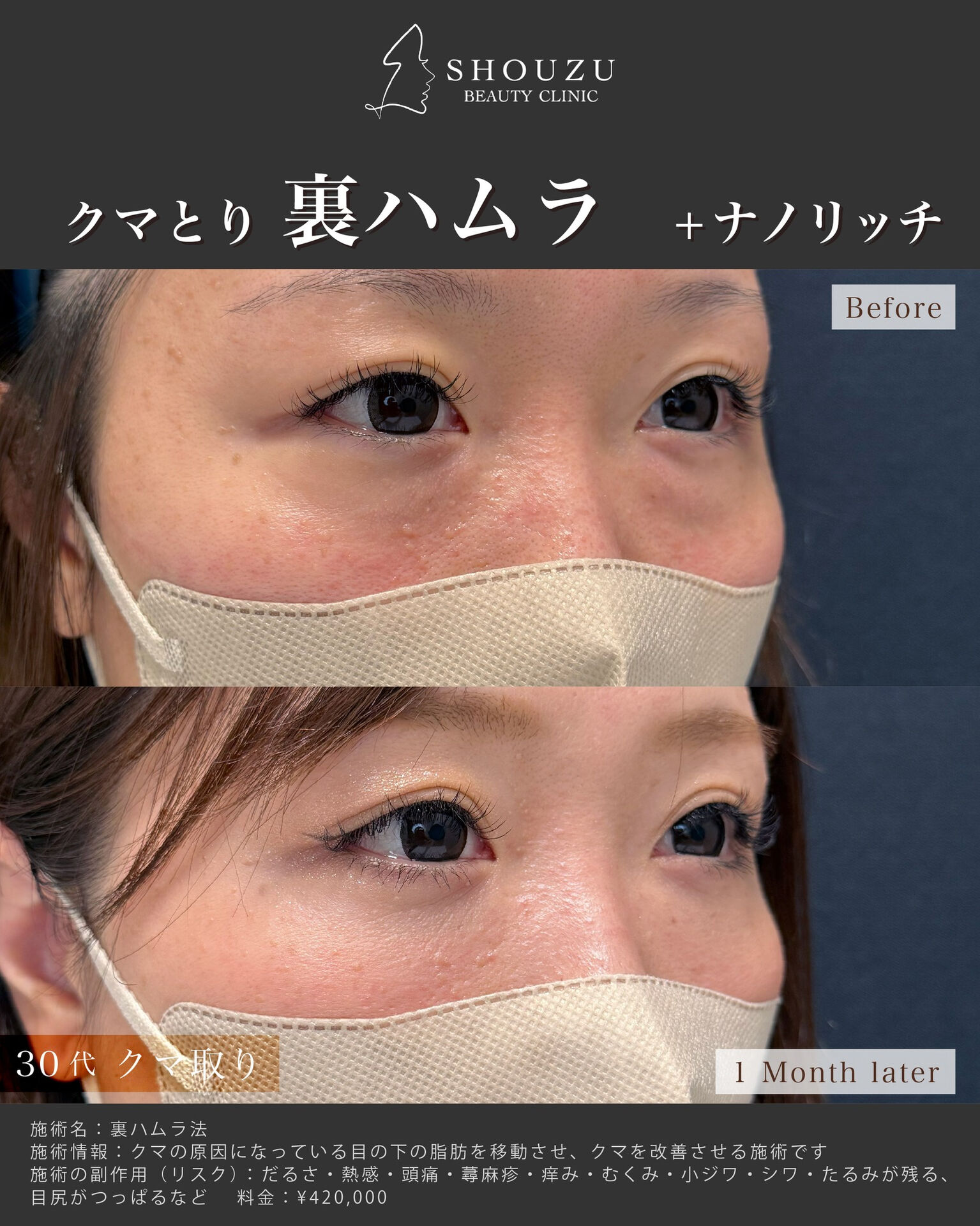 クマ取り施術 裏ハムラ法とナノリッチを施術されました
