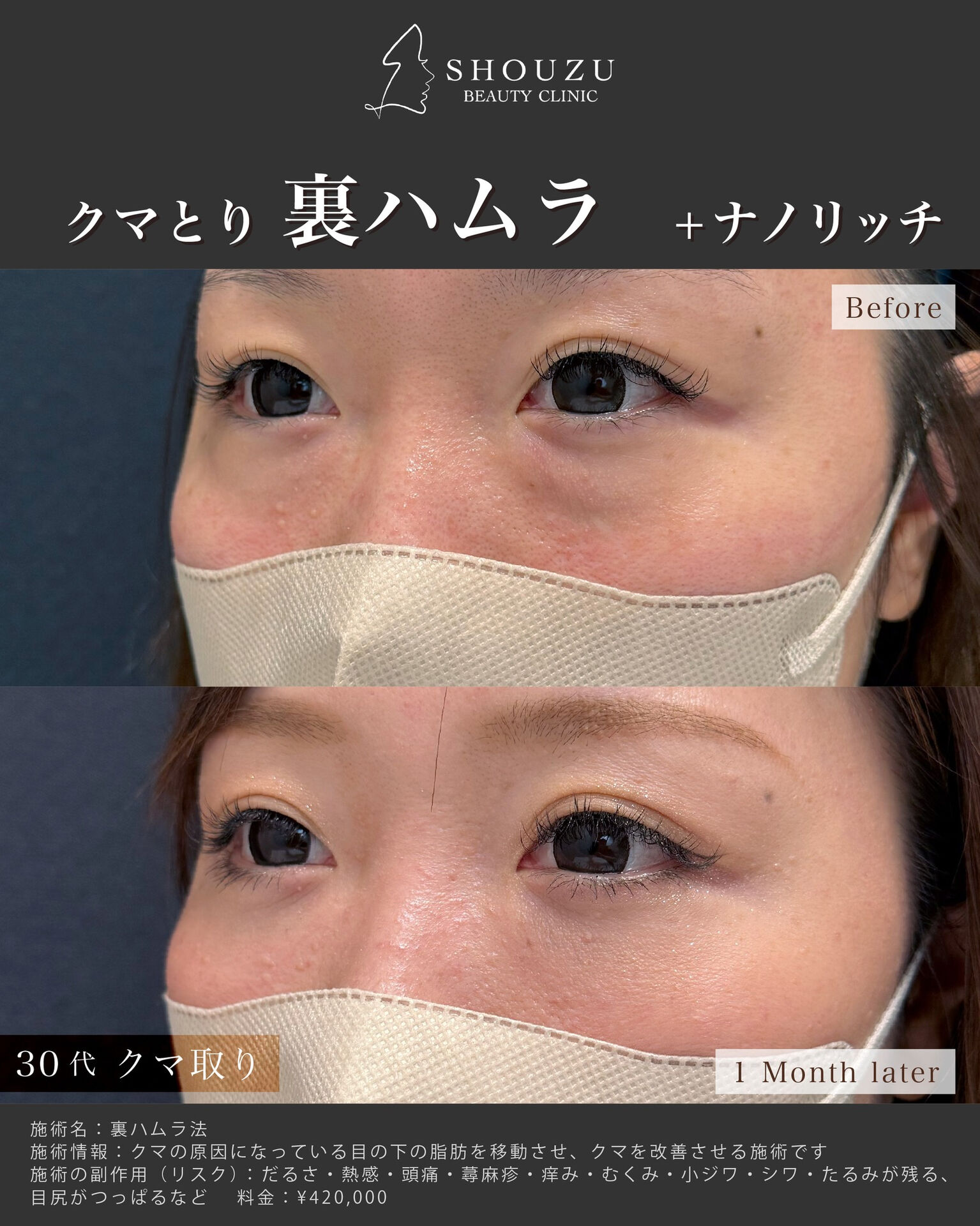 クマ取り施術 裏ハムラ法とナノリッチを施術されました