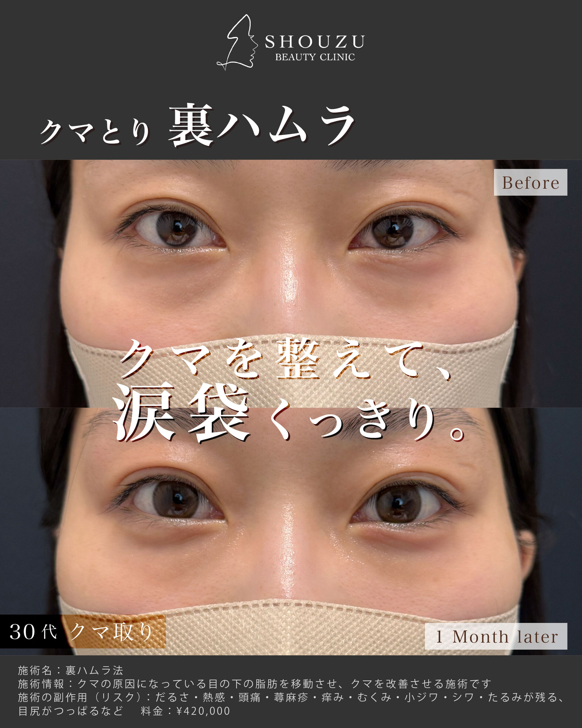 クマ取り施術 裏ハムラ法を施術されました