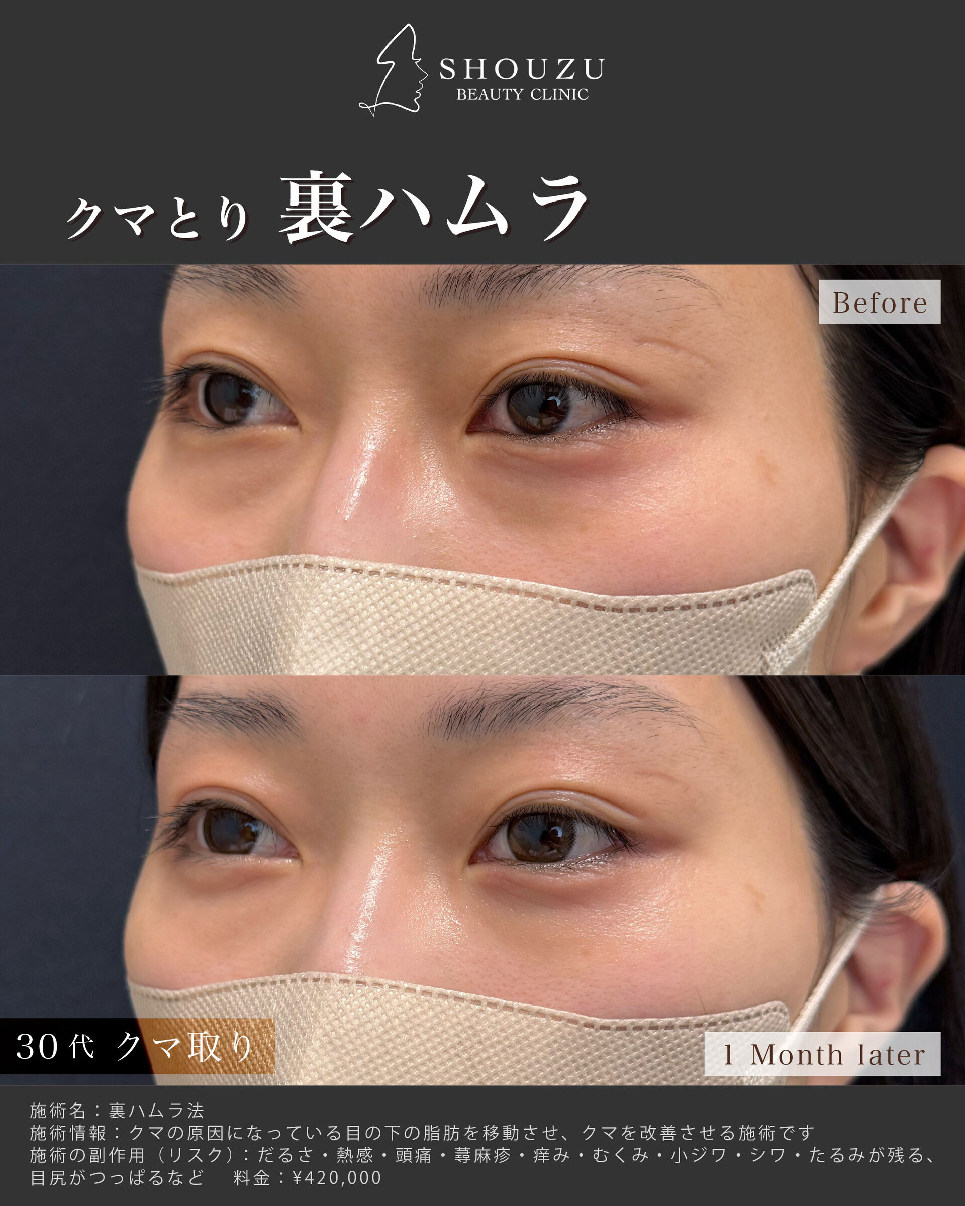 クマ取り施術 裏ハムラ法を施術されました