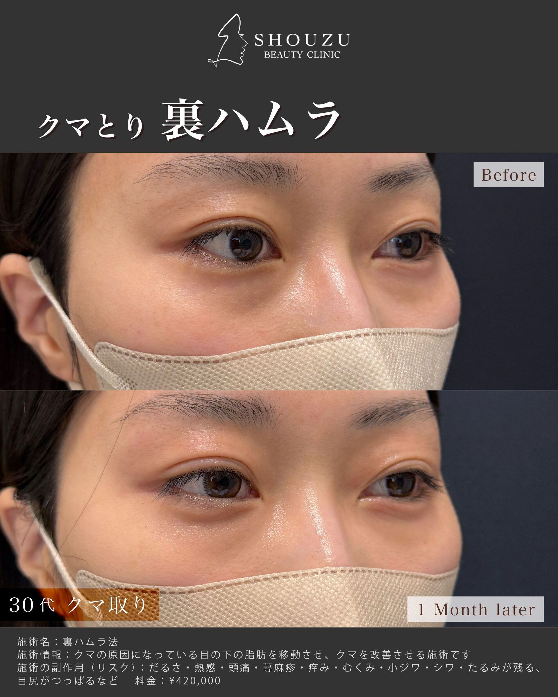 クマ取り施術 裏ハムラ法を施術されました